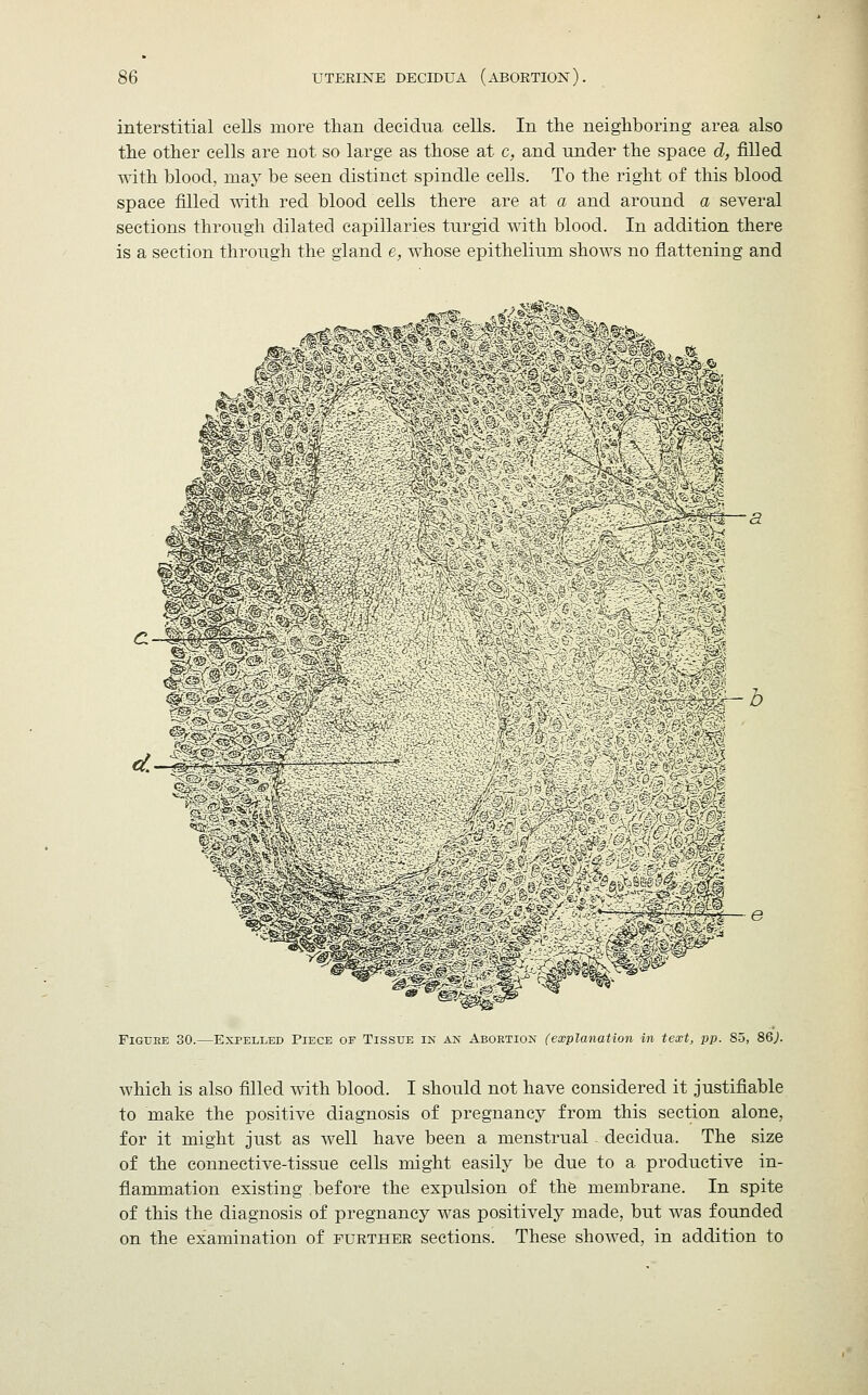 interstitial cells more than decidua cells. In the neighboring area also the other cells are not so large as those at c, and under the space d, filled with blood, may be seen distinct spindle cells. To the right of this blood space filled with red blood cells there are at a and around a several sections through dilated capillaries turgid with blood. In addition there is a section through the gland e, whose epithelium shows no flattening and Figure 30.—Expelled Piece of Tissue in an Abortion (explanation in text, pp. 85, 86;. which is also filled with blood. I should not have considered it justifiable to make the positive diagnosis of pregnancy from this section alone, for it might just as well have been a menstrual decidua. The size of the connective-tissue cells might easily be due to a productive in- flammation existing before the expulsion of the membrane. In spite of this the diagnosis of pregnancy was positively made, but was founded on the examination of further sections. These showed, in addition to