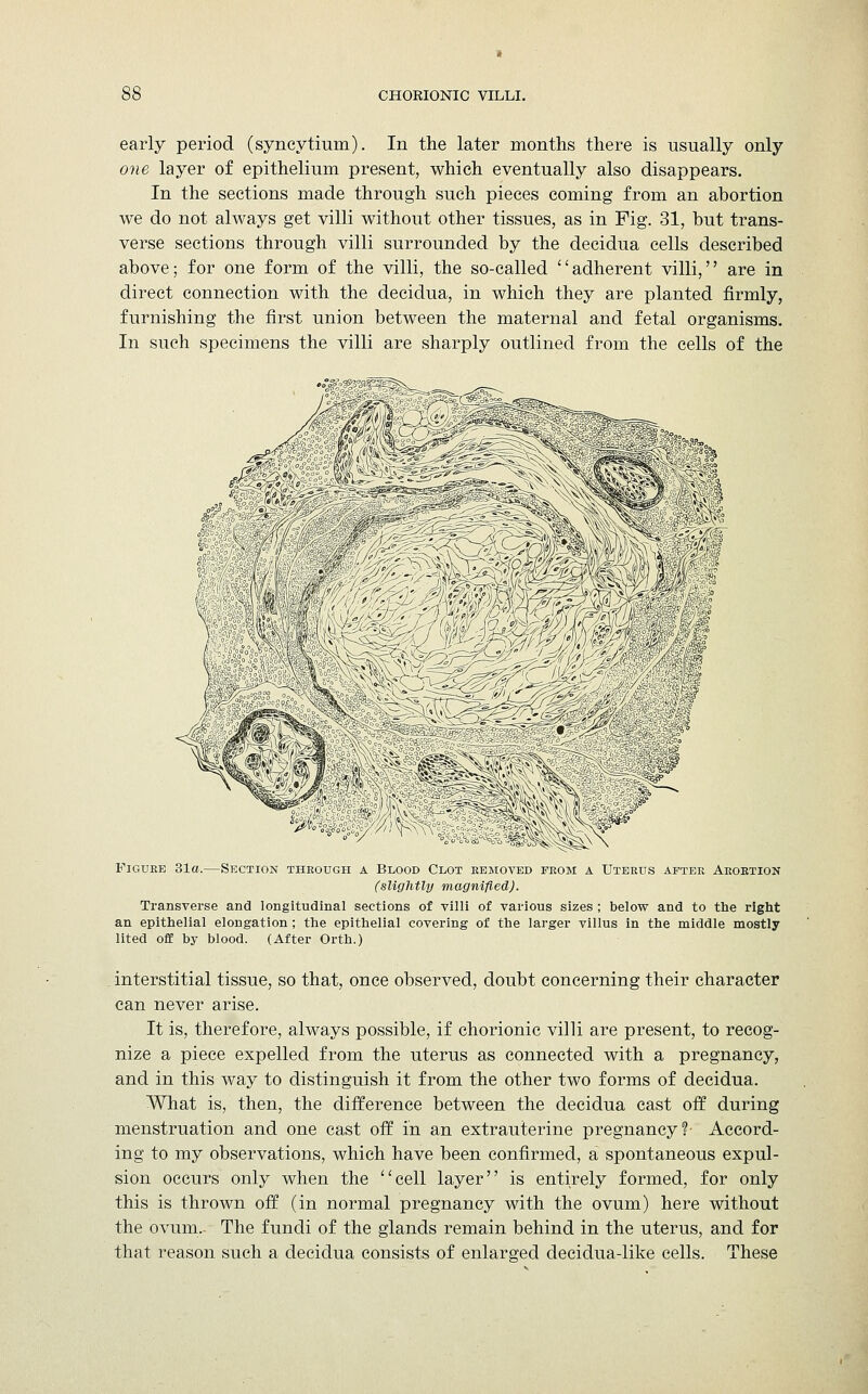 early period (syncytium). In the later months there is usually only one layer of epithelium present, which eventually also disappears. In the sections made through such pieces coming from an abortion we do not always get villi without other tissues, as in Fig. 31, but trans- verse sections through villi surrounded by the decidua cells described above; for one form of the villi, the so-called ''adherent villi, are in direct connection with the decidua, in which they are planted firmly, furnishing the first union between the maternal and fetal organisms. In such specimens the villi are sharply outlined from the cells of the Figure 31a.—Section through a Blood Clot removed from a Uterus after Aroetion (slightly magnified). Transverse and longitudinal sections of villi of various sizes ; below and to the right an epithelial elongation; the epithelial covering of the larger villus in the middle mostly lited off by blood. (After Orth.) interstitial tissue, so that, once observed, doubt concerning their character can never arise. It is, therefore, always possible, if chorionic villi are present, to recog- nize a piece expelled from the uterus as connected with a pregnancy, and in this way to distinguish it from the other two forms of decidua. What is, then, the difference between the decidua cast off during menstruation and one cast off in an extrauterine pregnancy?- Accord- ing to my observations, which have been confirmed, a spontaneous expul- sion occurs only when the cell layer is entirely formed, for only this is thrown off (in normal pregnancy with the ovum) here without the ovum. The fundi of the glands remain behind in the uterus, and for that reason such a decidua consists of enlarged decidua-like cells. These