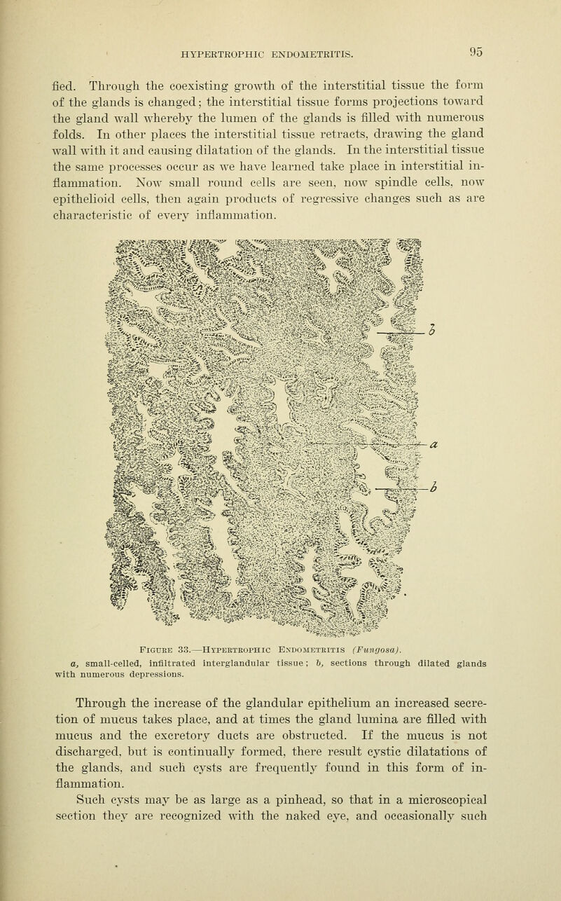 fied. Through the coexisting growth of the interstitial tissue the form of the glands is changed; the interstitial tissue forms projections toward the gland wall whereby the lumen of the glands is filled with numerous folds. In other places the interstitial tissue retracts, drawing the gland wall with it and causing dilatation of the glands. In the interstitial tissue the same processes occur as we have learned take place in interstitial in- flammation. Now small round cells are seen, now spindle cells, now epithelioid cells, then again products of regressive changes such as are characteristic of every inflammation. s^ffJSJf O '^||^ a ^fen ft--.; - - -'-: 0 .,*■/- ^ itm v.. . ,.;- i --& gs& MM *$§■§£ Figure 33.—Hypeeteophic Endometeitis (Fungosa). a, small-celled, infiltrated interglandular tissue; ~b, sections through dilated glands with numerous depressions. Through the increase of the glandular epithelium an increased secre- tion of mucus takes place, and at times the gland lumina are filled with mucus and the excretory ducts are obstructed. If the mucus is not discharged, but is continually formed, there result cystic dilatations of the glands, and such cysts are frequently found in this form of in- flammation. Such cysts may be as large as a pinhead, so that in a microscopical section they are recognized with the naked eye, and occasionally such