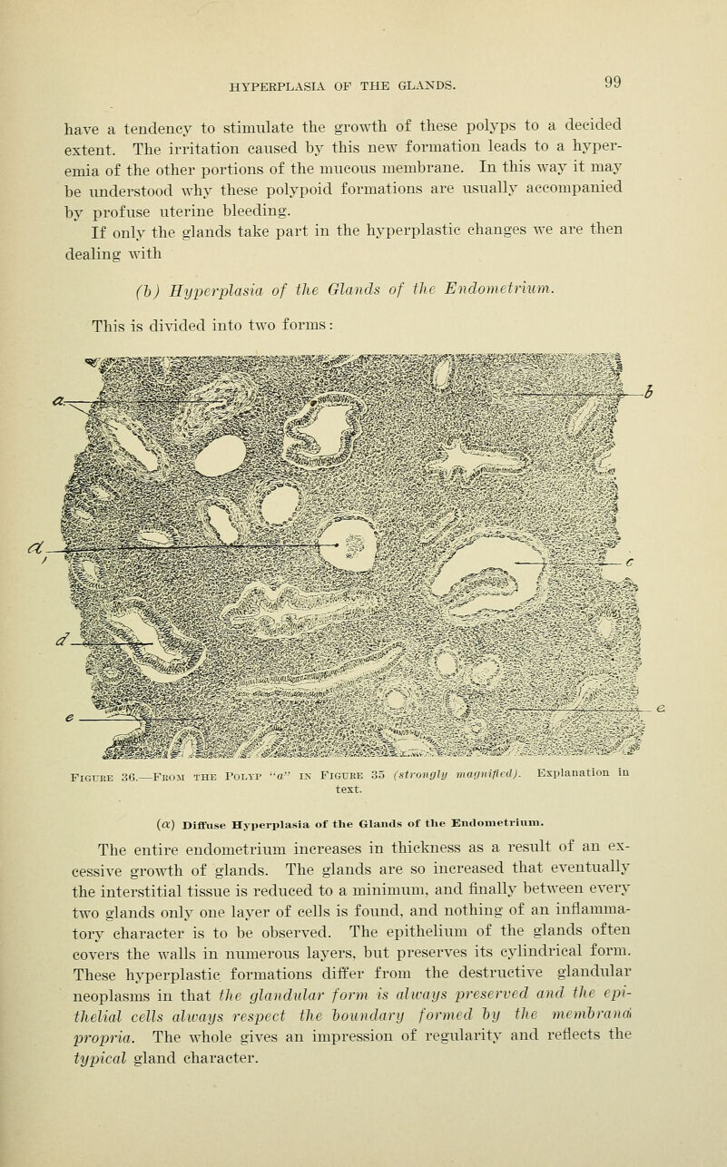 HYPERPLASIA OF THE GLANDS. have a tendency to stimulate the growth of these polyps to a decided extent. The irritation caused by this new formation leads to a hyper- emia of the other portions of the mucous membrane. In this way it may be understood why these polypoid formations are usually accompanied by profuse uterine bleeding. If only the glands take part in the hyperplastic changes we are then dealing with (b) Hyperplasia of the Glands of the Endometrium. This is divided into two forms: Figure 36.—From the Polyp a in Figure 35 (strongly n text. m aguified). Explanation in (<X) Diffuse Hyperplasia of the Glands of the Endometrium. The entire endometrium increases in thickness as a result of an ex- cessive growth of glands. The glands are so increased that eventually the interstitial tissue is reduced to a minimum, and finally between every two glands only one layer of cells is found, and nothing of an inflamma- tory character is to be observed. The epithelium of the glands often covers the walls in numerous layers, but preserves its cylindrical form. These hyperplastic, formations differ from the destructive glandular neoplasms in that the glandular form is always preserved and the epi- thelial cells always respect the boundary formed by the membrana propria. The whole gives an impression of regularity and reflects the typical gland character.