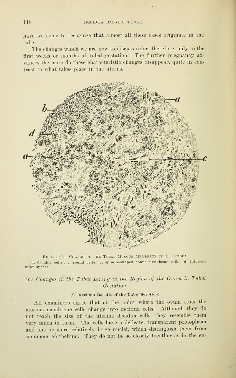 have we come to recognize that almost all these cases originate in the tube. The changes which we are now to discuss refer, therefore, only to the first weeks or months of tubal gestation. The further pregnancy ad- vances the more do these characteristic changes disappear, quite in con- trast to what takes place in the uterus. '■km. 4ttfc: Figure 41.—Change of the Tubal Mucous Membbaxe to a Decidua. a, decidua cells ; b, round cells; c, spindle-shaped connective-tissue cells ; d, intercel- lular spaces. (c) Changes in the Tubal Lining in the Region of the Ovum in Tubal Gestation. (oc) Decidua Basalis of the Tube (Serotina). All examiners agree that at the point where the ovum rests the mucous membrane cells change into decidua cells. Although they do not reach the size of the uterine decidua cells, they resemble them very much in form. The cells have a delicate, transparent protoplasm and one or more relatively large nuclei, which distinguish them from squamous epithelium. They do not lie so closely together as in the en-