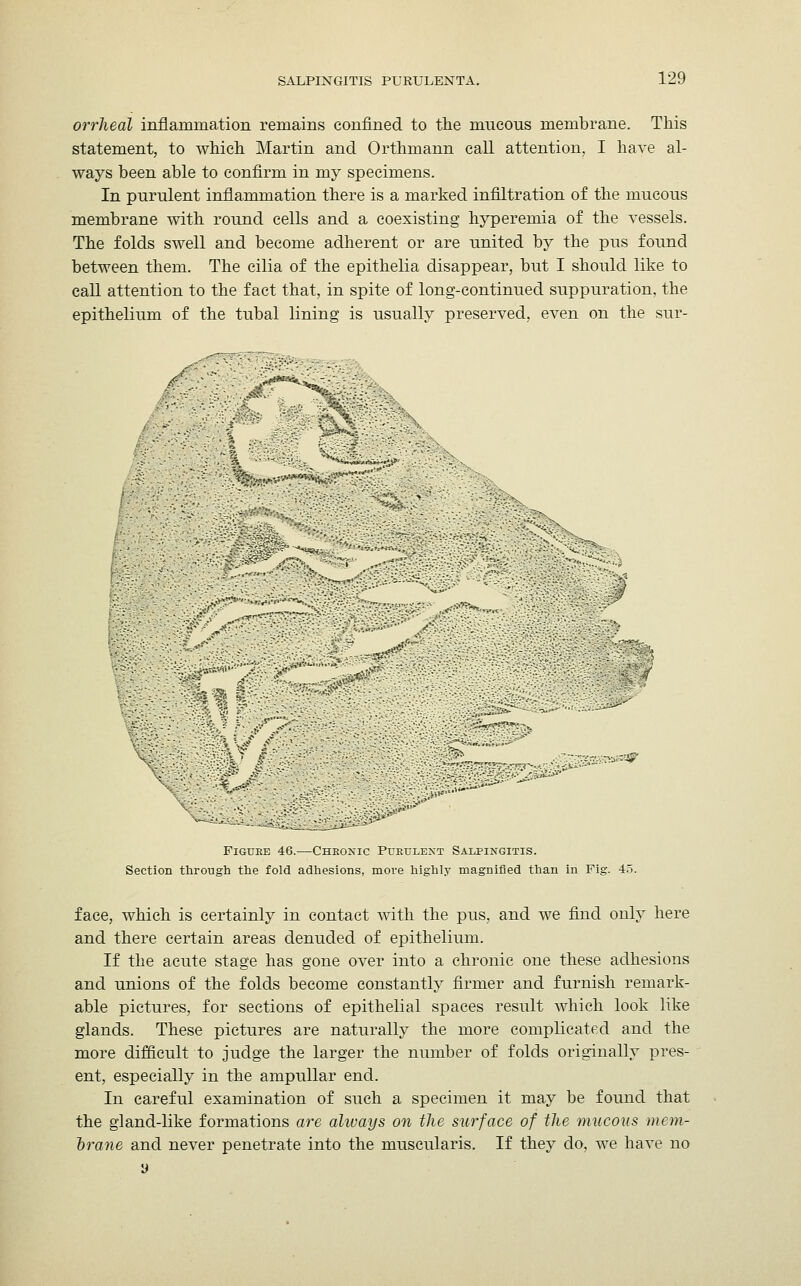 orrheal inflammation remains confined to the mucous membrane. This statement, to which Martin and Orthmann call attention, I have al- ways been able to confirm in my specimens. In purulent inflammation there is a marked infiltration of the mucous membrane with round cells and a coexisting hyperemia of the vessels. The folds swell and become adherent or are united by the pus found between them. The cilia of the epithelia disappear, but I should like to call attention to the fact that, in spite of long-continued suppuration, the epithelium of the tubal lining is usually preserved, even on the sur- tfT^S ; .^•;fl^. jjgSKSMKK! Figuee 46.—Cheonic Pubulext Salpingitis. Section through the fold adhesions, more highly magnified than in Fig. 45. face, which is certainly in contact with the pus, and we find only here and there certain areas denuded of epithelium. If the acute stage has gone over into a chronic one these adhesions and unions of the folds become constantly firmer and furnish remark- able pictures, for sections of epithelial spaces result which look like glands. These pictures are naturally the more complicated and the more difficult to judge the larger the number of folds originally pres- ent, especially in the ampullar end. In careful examination of such a specimen it may be found that the gland-like formations are always on the surface of the mucous mem- brane and never penetrate into the muscularis. If they do, we have no