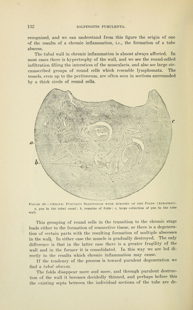 recognized, and we can understand from this figure the origin of one of the results of a chronic inflammation, i.e., the formation of a tube abscess. The tubal wall in chronic inflammation is almost always affected. In most cases there is hypertrophy of the wall, and we see the round-celled infiltration filling the interstices of the muscularis, and also see large cir- cumscribed groups of round cells which resemble lymphomata. The vessels, even up to the peritoneum, are often seen in sections surrounded by a thick circle of round cells. ¥ Figure 49.—Chronic Purulent Salpingitis with Atrophy op the Folds (Atrophic). a, pus in the tubal canal; h, remains of folds ; c, large collection of pus in the tube wall. This grouping of round cells in the transition to the chronic stage leads either to the formation of connective tissue, or there is a degenera- tion of certain parts with the resulting formation of multiple abscesses in the wall. In either case the muscle is gradually destroyed. The only difference is that in the latter case there is a greater fragility of the wall and in the former it is consolidated. In this way we are led di- rectly to the results which chronic inflammation may cause. If the tendency of the process is toward purulent degeneration we find a tubal abscess. The folds disappear more and more, and through purulent destruc- tion of the wall it becomes decidedly thinned, and perhaps before this the existing septa between the individual sections of the tube are de-