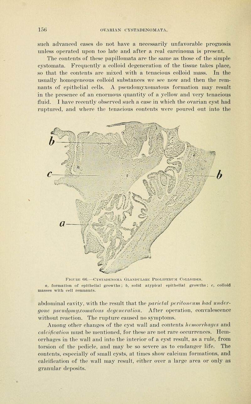 such advanced cases do not have a necessarily unfavorable prognosis unless operated upon too late and after a real carcinoma is present. The contents of these papillomata are the same as those of the simple cystomata. Frequently a colloid degeneration of the tissue takes place, so that the contents are mixed with a tenacious colloid mass. In the usually homogeneous colloid substances we see now and then the rem- nants of epithelial cells. A pseudomyxomatous formation may result in the presence of an enormous quantity of a yellow and very tenacious fluid. I have recently observed such a case in which the ovarian cyst had ruptured, and where the tenacious contents were poured out into the b ,/ a I *££, '„'.._, .#***'' Figure 66.—Cystadenoma Glandulaee Peoliferum Colloides. a, formation of epithelial growths; b, solid atypical epithelial growths; c, colloid masses with cell remnants. abdominal cavity, with the result that the parietal peritoneum had under- gone pseudomyxomatous degeneration. After operation, convalescence without reaction. The rupture caused no symptoms. Among other changes of the cyst wall and contents hemorrhages and calcification must be mentioned, for these are not rare occurrences. Hem- orrhages in the wall and into the interior of a cyst result, as a rule, from torsion of the pedicle, and may be so severe as to endanger life. The contents, especially of small cysts, at times show calcium formations, and calcification of the wall may result, either over a large area or only as granular deposits.