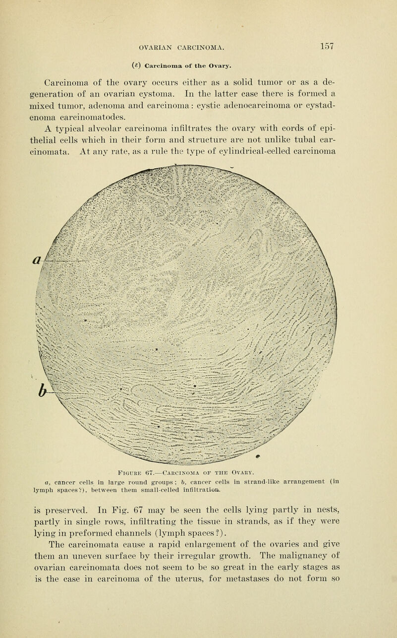 (s) Carcinoma of tlie Ovary. Carcinoma of the ovary occurs either as a solid tumor or as a de- generation of an ovarian cystoma. In the latter case there is formed a mixed tumor, adenoma and carcinoma: cystic adenocarcinoma or cystad- enoma carcinomatodes. A typical alveolar carcinoma infiltrates the ovary with cords of epi- thelial cells which in their form and structure are not unlike tubal car- cinomata. At any rate, as a rule the type of cylindrical-celled carcinoma -<•■< a IA / Figure 67.—Carcinoma of the Ovary. a, cancer cells in large round groups ; h, cancer cells in strand-like arrangement (in lymph spaces?), between them small-celled infiltration. is preserved. In Fig. 67 may be seen the cells lying partly in nests, partly in single rows, infiltrating the tissue in strands, as if they were lying in preformed channels (lymph spaces?). The carcinomata cause a rapid enlargement of the ovaries and give them an uneven surface by their irregular growth. The malignancy of ovarian carcinomata does not seem to be so great in the early stages as is the case in carcinoma of the uterus, for metastases do not form so