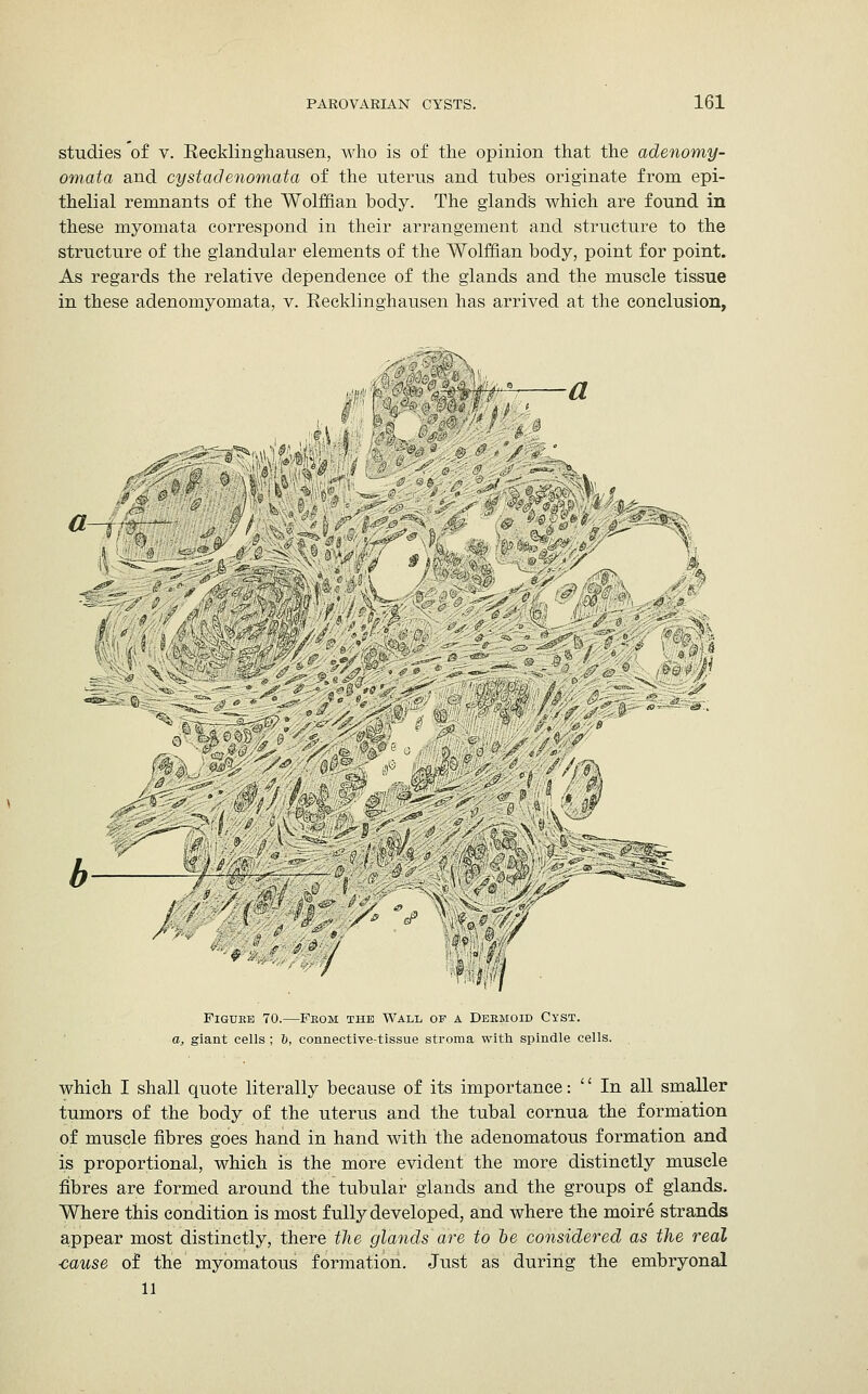 studies of v. Recklinghausen, who is of the opinion that the adenomy- omata and cyst adenomata of the uterus and tubes originate from epi- thelial remnants of the Wolffian body. The gland's which are found in these myomata correspond in their arrangement and structure to the structure of the glandular elements of the Wolffian body, point for point. As regards the relative dependence of the glands and the muscle tissue in these adenomyomata, v. Recklinghausen has arrived at the conclusion, :r§\ |fj>ij —d 9m MEM™ ^ ilWte  , • mm> a-4M^< ' S fv SS^i^C^ ^'^^\^3%- t—r -'; -I —■ ■ ,? .-v / •.*»•■ \?-- « lie- * p#--c^ ** *<*- ee. -*' ■ ^ ::> ,#- <^m^''/f' *^:.S:>v^ -c*S:'X •V-1 't $ H ' r y-. '&&&&■■■**'  *y/a&®®P J • &.'■•<» 3 9:/ 4?/*'? b V'^ Vit^^tjr. ae^ '..'■■ ;-7 Figuee 70.—Feom the Wall of a Desmoid Cyst. a, giant cells ; b, connective-tissue stroma with spindle cells. which I shall quote literally because of its importance:  In all smaller tumors of the body of the uterus and the tubal cornua the formation of muscle fibres goes hand in hand with the adenomatous formation and is proportional, which is the more evident the more distinctly muscle fibres are formed around the tubular glands and the groups of glands. Where this condition is most fully developed, and where the moire strands appear most distinctly, there tlie glands are to be considered as the real ■cause of the myomatous formation. Just as during the embryonal 11