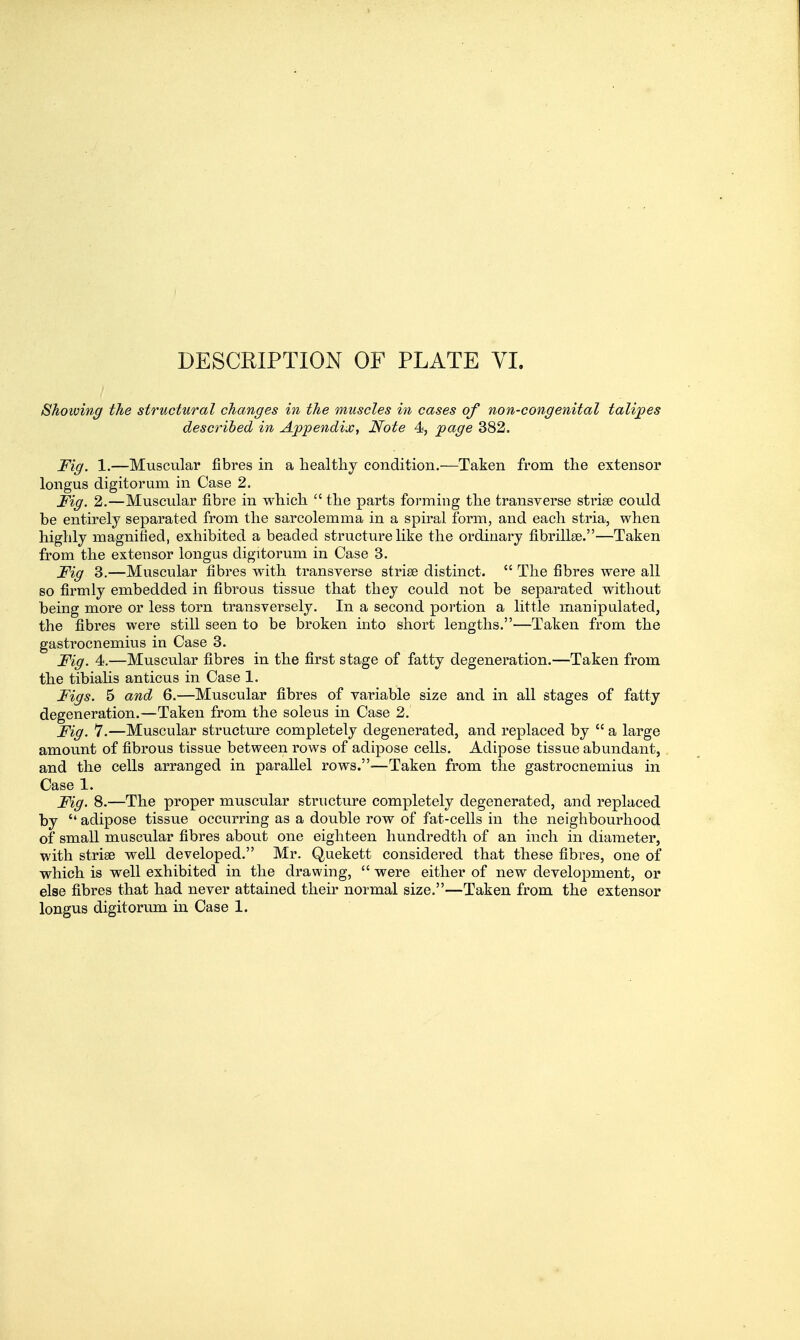 Shoioing the structural changes in the muscles in cases of non-congenital talijpes described in Appendix, Note 4, page 382. Fig. 1.—Muscular fibres in a liealtlij condition.—Taken from tlie extensor longus digitorum in Case 2. Fig. 2.—Muscular fibre in wliich  tlie parts forming tlie transverse strise could be entirely separated from tlie sarcolemma in a spiral form, and each stria, when highly magnified, exhibited a beaded structure like the ordinary fibrillse.—Taken from the extensor longus digitorum in Case 3. Fig 3.—Muscular fibres with transverse strise distinct.  The fibres were all so firmly embedded in fibi'ous tissue that they could not be separated without being more or less torn transversely. In a second portion a little manipulated, the fibres were still seen to be broken into short lengths.—Taken from the gastrocnemius in Case 3. Fig. 4.—Muscular fibres in the first stage of fatty degeneration.—Taken from the tibiahs anticus in Case 1. Figs. 5 and 6.—Muscular fibres of variable size and in all stages of fatty degeneration.—Taken from the soleus in Case 2. Fig. 7.—Muscular structure completely degenerated, and replaced by  a large amount of fibrous tissue between rows of adipose cells. Adipose tissue abundant, and the cells arranged in parallel rows.'—Taken from the gastrocnemius in Case 1. Fig. 8.—The proper muscular structure completely degenerated, and replaced by  adipose tissue occurring as a double row of fat-cells in the neighbourhood of small muscular fibres about one eighteen hundredth of an inch in diameter, with striae well developed. Mr. Quekett considered that these fibres, one of which is well exhibited in the drawing,  were either of new development, or else fibres that had never attained their normal size.—Taken from the extensor longus digitorum in Case 1.