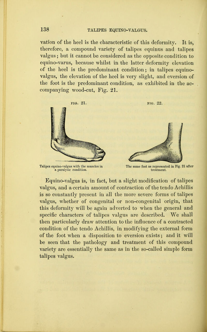 vation of the heel is the characteristic of this deformity. It is, therefore, a compound variety of talipes equinus and talipes valgus; but it cannot be considered as the opposite condition to equino-varus, because whilst in the latter deformity elevation of the heel is the predominant condition; in talipes equino- valgus, the elevation of the heel is very slight, and eversion of the foot is the predominant condition, as exhibited in the ac- companying wood-cut. Fig. 21. Tia. 21. FIG. 22. Talipes equino-valgus witli the muscles in The same foot as represented in Fig. 21 after a paralytic condition. treatment. Equino-valgus is, in fact, but a slight modification of talipes valgus, and a certain amount of contraction of the tendo Achillis is so constantly present in all the more severe forms of talipes valgus, whether of congenital or non-congenital origin, that this deformity will be again adverted to when the general and specific characters of talipes valgus are described. We shall then particularly draw attention to the influence of a contracted condition of the tendo Achillis, in modifying the external form of the foot when a disposition to eversion exists; and it will be seen that the pathology and treatment of this compound variety are essentially the same as in the so-called simple form talipes valgus.