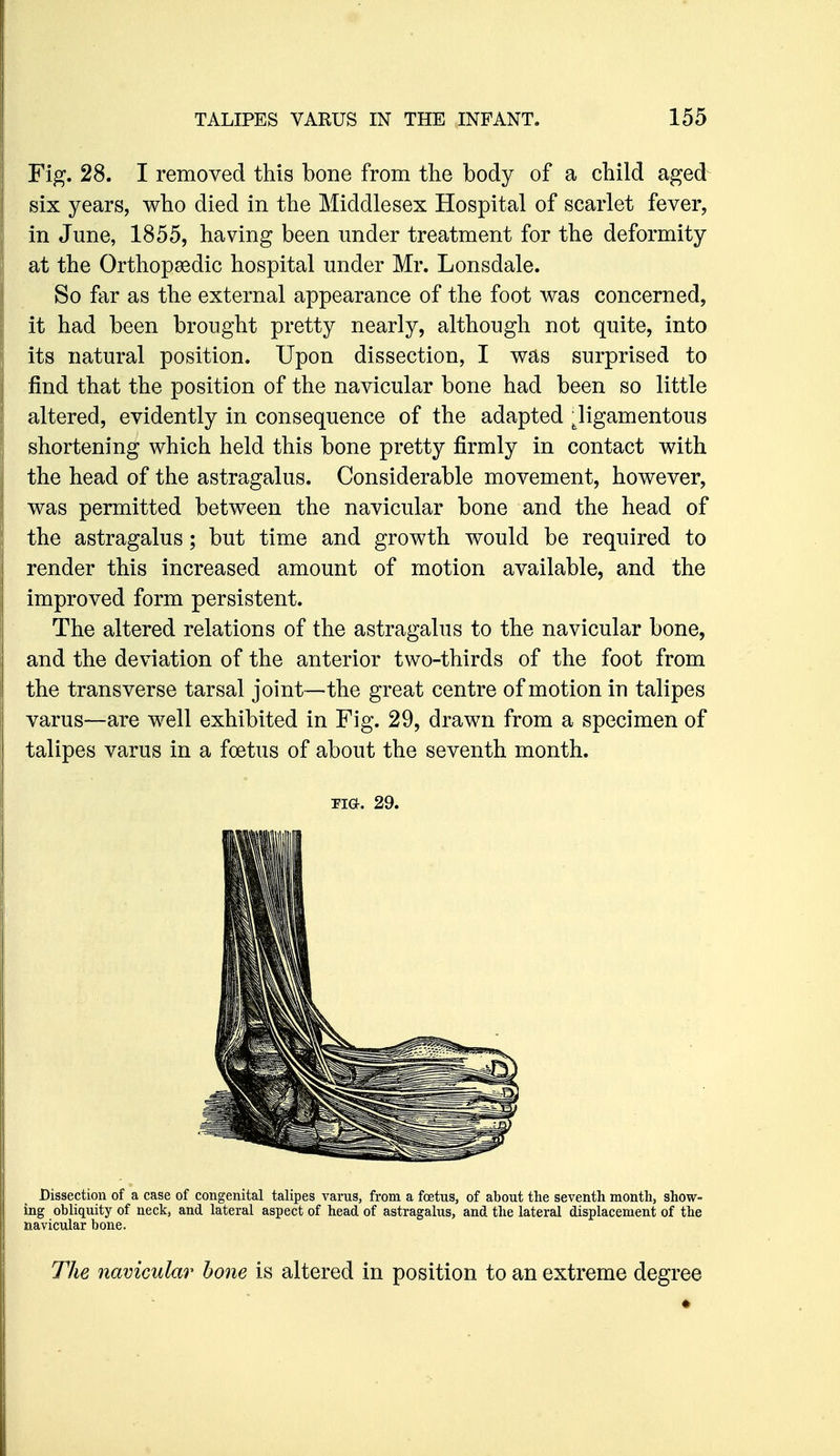 Fig. 28. I removed this bone from the body of a child aged^ six years, who died in the Middlesex Hospital of scarlet fever, in June, 1855, having been under treatment for the deformity at the Orthopaedic hospital under Mr. Lonsdale. So far as the external appearance of the foot was concerned, it had been brought pretty nearly, although not quite, into its natural position. Upon dissection, I was surprised to find that the position of the navicular bone had been so little altered, evidently in consequence of the adapted ^ligamentous shortening which held this bone pretty firmly in contact with the head of the astragalus. Considerable movement, however, was permitted between the navicular bone and the head of the astragalus; but time and growth would be required to render this increased amount of motion available, and the improved form persistent. The altered relations of the astragalus to the navicular bone, and the deviation of the anterior two-thirds of the foot from the transverse tarsal joint—the great centre of motion in talipes varus—are well exhibited in Fig. 29, drawn from a specimen of talipes varus in a foetus of about the seventh month. Tia. 29. Dissection of a case of congenital talipes varus, from a foetus, of about the seventh month, show- ing obliquity of neck, and lateral aspect of head of astragalus, and the lateral displacement of the navicular bone. The navicular bone is altered in position to an extreme degree