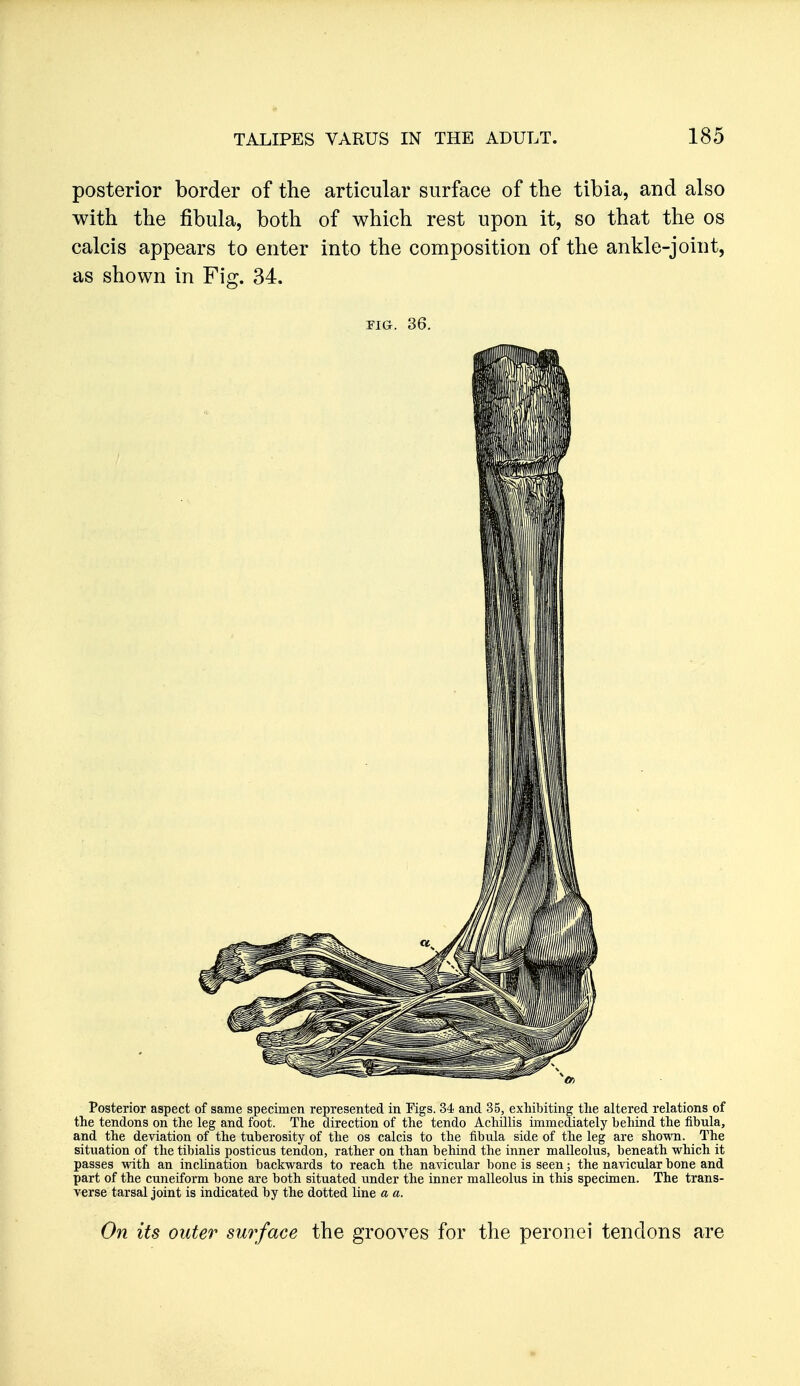 posterior border of the articular surface of the tibia, and also with the fibula, both of which rest upon it, so that the os calcis appears to enter into the composition of the ankle-joint, as shown in Fig. 34. YIG. 36. Posterior aspect of same specimen represented in Figs. 34 and 35, exhibiting the altered relations of the tendons on the leg and foot. The direction of the tendo AchUlis niimcdiately behind the fibula, and the deviation of the tuberosity of the os calcis to the fibula side of the leg are shown. The sitviation of the tibialis posticus tendon, rather on than behind the inner malleolus, beneath which it passes with an incUnation backwards to reach the navicular bone is seen; the navicular bone and part of the cuneiform bone are both situated under the inner malleolus in this specimen. The trans- verse tarsal joint is indicated by the dotted line a a. On its outer surface the grooves for the peronei tendons are