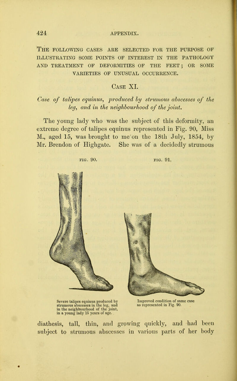 The following cases are selected for the purpose of illustrating soime points of interest in the pathology and treatment of deformities of the feet ; or some varieties of unusual occurrence. Case XL Case of talipes equinus, produced hy strumous abscesses of the leg, and in the neighbourhood of the joint. The young lady who was the subject of this deformity, an extreme degree of talipes equinus represented in Fig. 90, Miss M., aged 15, was brought to me on the 18th July, 1854, by Mr. Brendon of Highgate. She was of a decidedly strumous pia. 90. pia. 91. Severe talipes equinus produced by Improved condition of same case strumous abscesses in tlie leg, and as represented in Tig. 90. in the neighbourhood of the joint, in a young lady 15 years of age. , diathesis, tall, thin, and growing quickly, and had been subject to strumous abscesses in various parts of her body