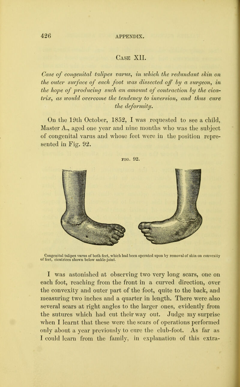 Case Xll. Case of coiigenital talipes varus, in loliich the redundant shin on the outer surface of each foot ivas dissected off by a surgeon, in the hope of p>roducing such an amount of contraction hy the cica- trix, as woidd overcome the tendency to inversion, and thus cure the deformity. On the 19th October, 1852, I was requested to see a child, Master A., aged one year and nine months who was the subject of congenital varus and whose feet were in the position repre- sented in Fig. 92. FIG. 92. Congenital talipes varus of botli feet, wliicli had been operated upon by removal of skin on convexity of feet, cicatrices shown below ankle-joint. I was astonished at observing two very long scars, one on each foot, reaching from the front in a curved direction, over the convexity and outer part of the foot, quite to the back, and measuring two inches and a quarter in length. There were also several scars at right angles to the larger ones, evidently from the sutures which had cut their way out. Judge my surprise when I learnt that these were the scars of operations performed only about a year previously to cure the club-foot. As far as I could learn from the family, in explanation of this extra-