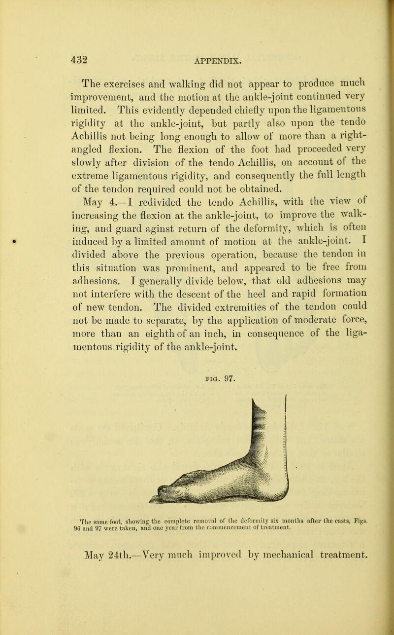 The exercises and walking did not appear to produce miicli improvement, and tlie motion at the ankle-joint continued very limited. This evidently depended chiefly upon the ligamentous rigidity at the ankle-joint, but partly also upon the tendo Achillis not being long enough to allow of more than a right- angled flexion. The flexion of the foot had proceeded very slowly after division of the tendo Achillis, on account of the extreme ligamentous rigidity, and consequently the full length of the tendon required could not be obtained. May 4.—I redivided the tendo Achillis, with the view of increasing the flexion at the ankle-joint, to improve the walk- ing, and guard aginst return of the deformity, which is often induced by a limited amount of motion at the ankle-joint. I divided above the previous operation, because the tendon in this situation was prominent, and appeared to be free from adhesions. I generally divide below, that old adhesions may not interfere with the descent of the heel and rapid formation of new tendon. The divided extremities of the tendon could not be made to separate, by the application of moderate force, more than an eighth of an inch, in consequence of the liga- mentous rigidity of the ankle-joint. riG. 97. Tlie, same foot, sliowing tlie complete removal of the deformity six months after the easts, Figs. 96 and 97 were taken, and one year from the commencement of treatment. May 24th.—Very mucli improved by mechanical treatment.