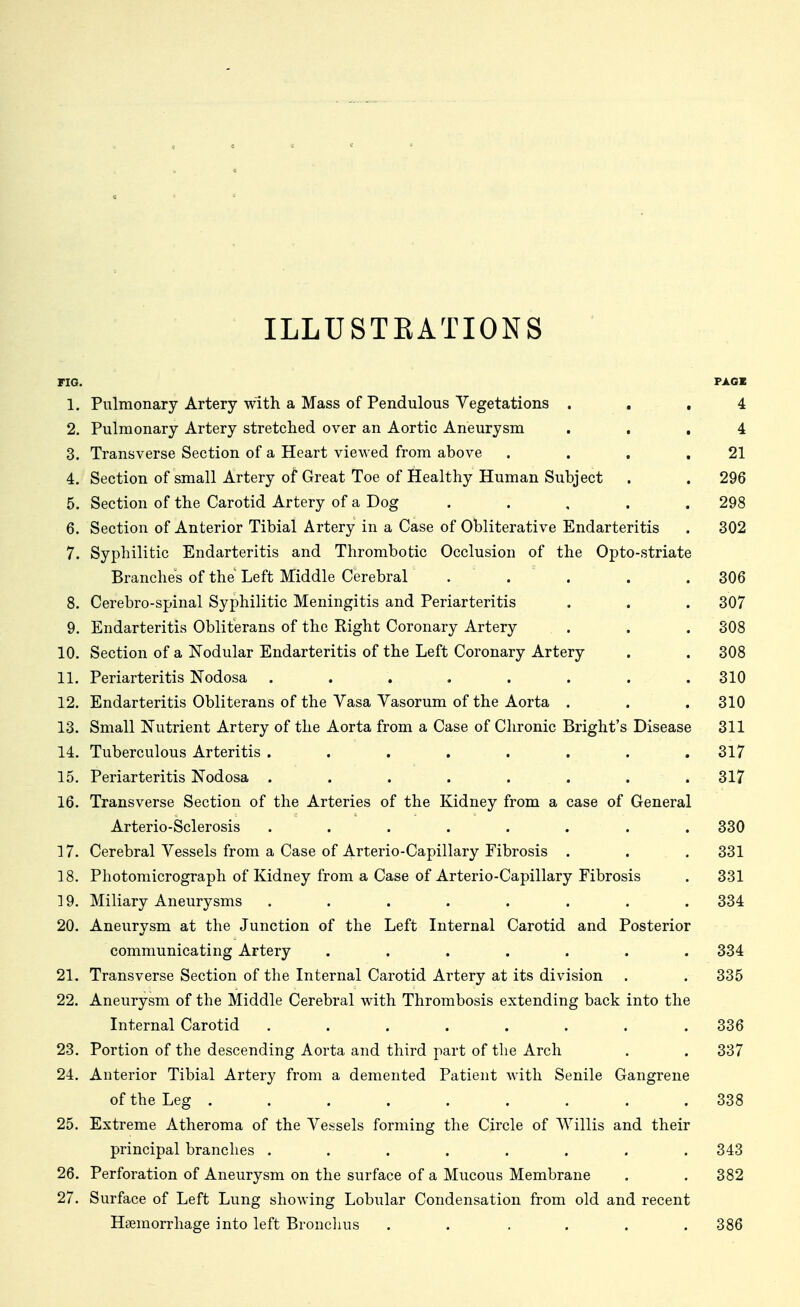 ILLUSTRATIONS FIG. 1. Pulmonary Artery with a Mass of Pendulous Vegetations ... 4 2. Pulmonary Artery stretched over an Aortic Aneurysm ... 4 3. Transverse Section of a Heart viewed from above . . . .21 4. Section of small Artery of Great Toe of Healthy Human Subject . . 296 5. Section of the Carotid Artery of a Dog . . . . .298 6. Section of Anterior Tibial Artery in a Case of Obliterative Endarteritis . 302 7. Syphilitic Endarteritis and Thrombotic Occlusion of the Opto-striate Branches of the Left Middle Cerebral . . . . . 306 8. Cerebro-spinal Syphilitic Meningitis and Periarteritis . . . 307 9. Endarteritis Obliterans of the Right Coronary Artery . . . 308 10. Section of a Nodular Endarteritis of the Left Coronary Artery . . 308 11. Periarteritis Nodosa ........ 310 12. Endarteritis Obliterans of the Yasa Yasorum of the Aorta . . .310 13. Small Nutrient Artery of the Aorta from a Case of Chronic Bright's Disease 311 14. Tuberculous Arteritis ........ 317 15. Periarteritis Nodosa ........ 317 16. Transverse Section of the Arteries of the Kidney from a case of General Arterio-Sclerosis ........ 330 17. Cerebral Yessels from a Case of Arterio-Capillary Fibrosis . . . 331 18. Photomicrograph of Kidney from a Case of Arterio-Capillary Fibrosis . 331 19. Miliary Aneurysms ........ 334 20. Aneurysm at the Junction of the Left Internal Carotid and Posterior communicating Artery ....... 334 21. Transverse Section of the Internal Carotid Artery at its division . . 335 22. Aneurysm of the Middle Cerebral with Thrombosis extending back into the Internal Carotid . . . . . . . .336 23. Portion of the descending Aorta and third part of the Arch . . 337 24. Anterior Tibial Artery from a demented Patient with Senile Gangrene of the Leg . . . . . . , . . 338 25. Extreme Atheroma of the Yessels forming the Circle of Willis and their principal branches ........ 343 26. Perforation of Aneurysm on the surface of a Mucous Membrane . . 382 27. Surface of Left Lung showing Lobular Condensation from old and recent Haemorrhage into left Bronclius . . . . . .386
