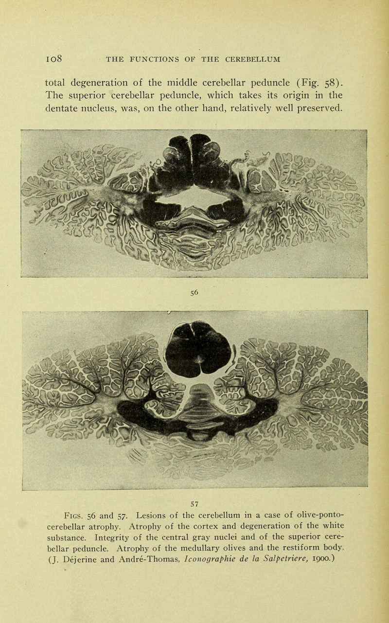 total degeneration of the middle cerebellar peduncle (Fig. 58). The superior cerebellar peduncle, which takes its origin in the dentate nucleus, was, on the other hand, relatively well preserved. 57 Figs. 56 and 57. Lesions of the cerebellum in a case of olive-ponto- cerebellar atrophy. Atrophy of the cortex and degeneration of the white substance. Integrity of the central gray nuclei and of the superior cere- bellar peduncle. Atrophy of the medullary olives and the restiform body. (J. Dejerine and Andre-Thomas, Iconographie de la Salpetriere, 1900.)