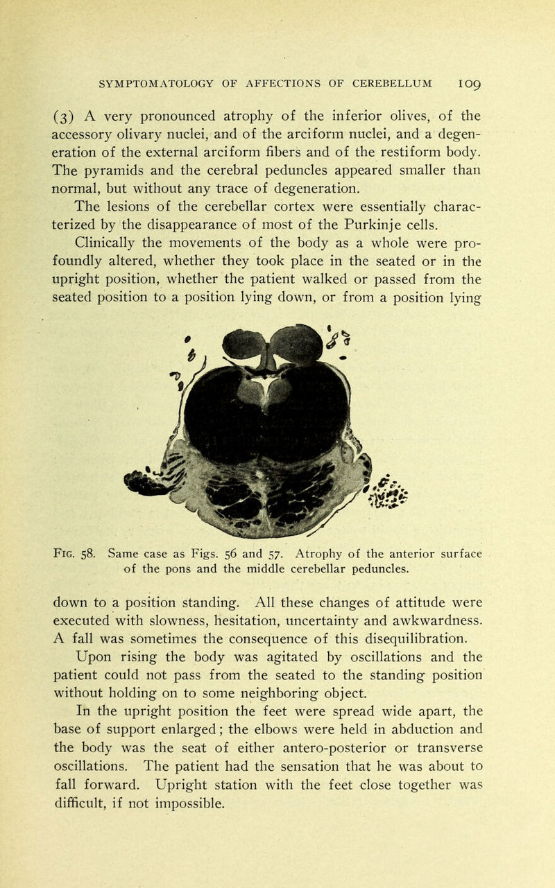 (3) A very pronounced atrophy of the inferior oUves, of the accessory oHvary nuclei, and of the arciform nuclei, and a degen- eration of the external arciform fibers and of the restiform body. The pyramids and the cerebral peduncles appeared smaller than normal, but without any trace of degeneration. The lesions of the cerebellar cortex were essentially charac- terized by the disappearance of most of the Purkinje cells. Clinically the movements of the body as a whole were pro- foundly altered, whether they took place in the seated or in the upright position, whether the patient walked or passed from the seated position to a position lying down, or from a position lying Fig. 58. Same case as Figs. 56 and 57. Atrophy of the anterior surface of the pons and the middle cerebellar peduncles. down to a position standing. All these changes of attitude were executed with slowness, hesitation, uncertainty and awkwardness. A fall was sometimes the consequence of this disequilibration. Upon rising the body was agitated by oscillations and the patient could not pass from the seated to the standing position without holding on to some neighboring object. In the upright position the feet were spread wide apart, the base of support enlarged; the elbows were held in abduction and the body was the seat of either antero-posterior or transverse oscillations. The patient had the sensation that he was about to fall forward. Upright station with the feet close together was difficult, if not impossible.