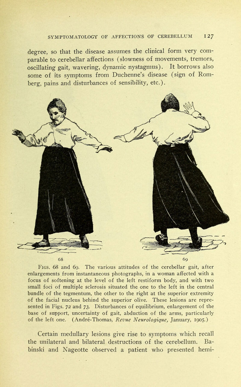 degree, so that the disease assumes the clinical form very com- parable to cerebellar affections (slowness of movements, tremors, oscillating gait, wavering, dynamic nystagmus). It borrows also some of its symptoms from Duchenne's disease (sign of Rom- berg, pains and disturbances of sensibility, etc.). 68 Figs. 68 and 69. The various attitudes of the cerebellar gait, after enlargements from instantaneous photographs, in a woman affected with a focus of softening at the level of the left restiform body, and with two small foci of multiple sclerosis situated the one to the left in the central bundle of the tegmentum, the other to the right at the superior extremity of the facial nucleus behind the superior olive. These lesions are repre- sented in Figs. 72 and 73. Disturbances of equilibrium, enlargement of the base of support, uncertainty of gait, abduction of the arms, particularly of the left one. (Andre-Thomas, Revue Neurologique, January, 1905.) Certain medullary lesions give rise to symptoms which recall the unilateral and bilateral destructions of the cerebellum. Ba- binski and Nageotte observed a patient who presented hemi-