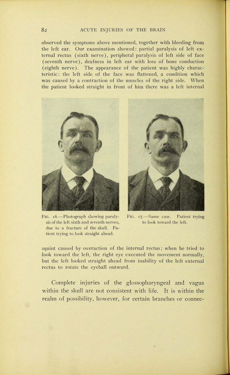 observed the symptoms above mentioned, together v^ith bleeding from the left ear. Our examination showed: partial paralysis of left ex- ternal rectus (sixth nerve), peripheral paralysis of left side of face (seventh nerve), deafness in left ear v^ith loss of bone conduction (eighth nerve). The appearance of the patient was highly charac- teristic : the left side of the face was flattened, a condition which was caused by a contraction of the muscles of the right side. When the patient looked straight in front of him there was a left internal Fig. i6.—Photograph showing paraly- Fig. 17.—Same case. Patient trying sis of the left sixth and seventh nerves, to look toward the left, due to a fracture of the skull. Pa- tient trying to look straight ahead. squint caused by overaction of the internal rectus; when he tried to look toward the left, the right eye executed the movement normally, but the left looked straight ahead from inability of the left external rectus to rotate the eyeball outward. Complete injuries of the glossopharyngeal and vagus within the skull are not consistent with life. It is within the realm of possibility, however, for certain branches or connec-