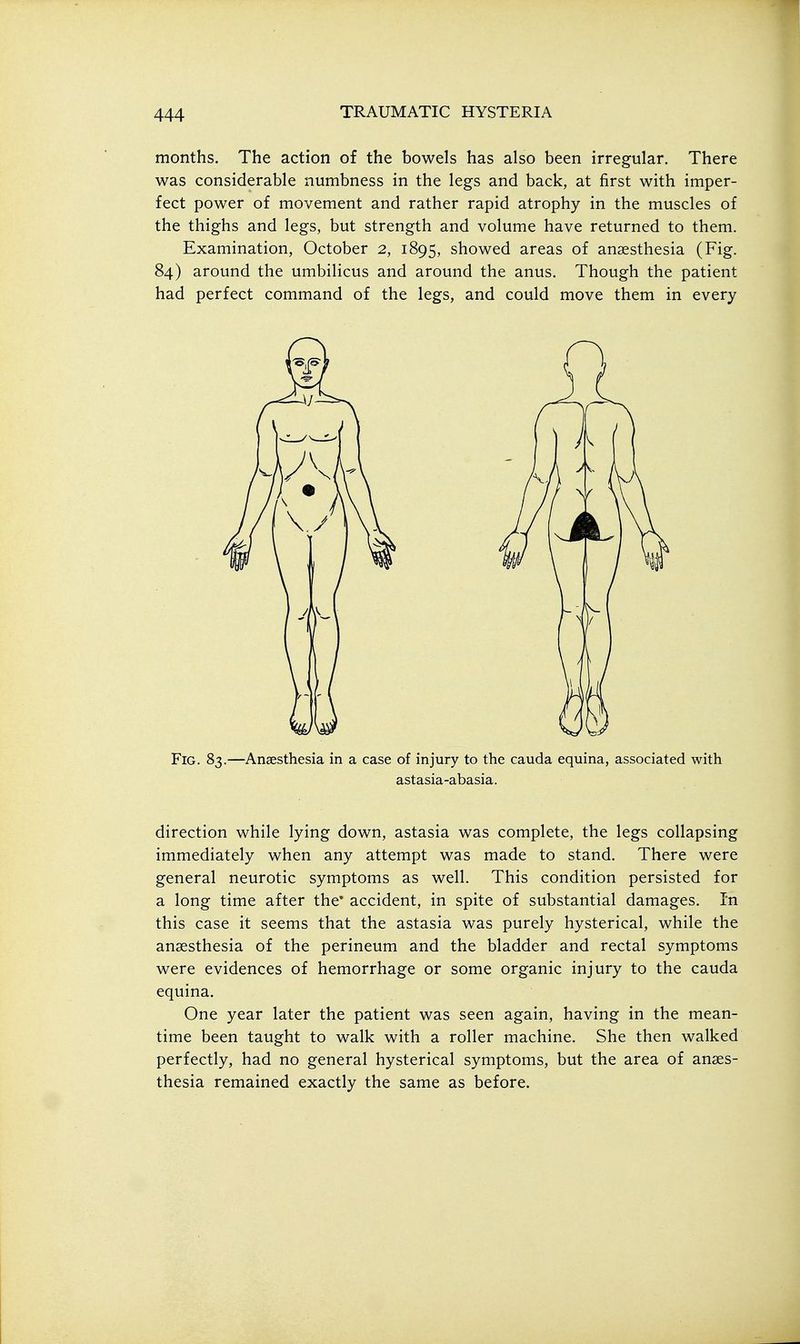 months. The action of the bowels has also been irregular. There was considerable numbness in the legs and back, at first with imper- fect power of movement and rather rapid atrophy in the muscles of the thighs and legs, but strength and volume have returned to them. Examination, October 2, 1895, showed areas of anaesthesia (Fig. 84) around the umbilicus and around the anus. Though the patient had perfect command of the legs, and could move them in every Fig. 83.—Anaesthesia in a case of injury to the cauda equina, associated with astasia-abasia. direction while lying down, astasia was complete, the legs collapsing immediately when any attempt was made to stand. There were general neurotic symptoms as well. This condition persisted for a long time after the' accident, in spite of substantial damages. In this case it seems that the astasia was purely hysterical, while the anaesthesia of the perineum and the bladder and rectal symptoms were evidences of hemorrhage or some organic injury to the cauda equina. One year later the patient was seen again, having in the mean- time been taught to walk with a roller machine. She then walked perfectly, had no general hysterical symptoms, but the area of anaes- thesia remained exactly the same as before.