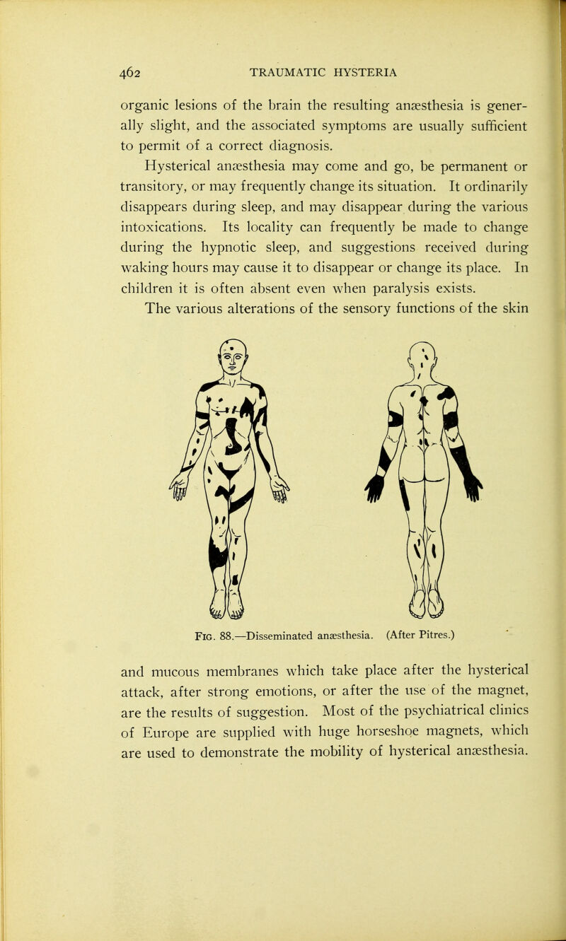 organic lesions of the brain the resulting anaesthesia is gener- ally slight, and the associated symptoms are usually sufficient to permit of a correct diagnosis. Hysterical anaesthesia may come and go, be permanent or transitory, or may frequently change its situation. It ordinarily disappears during sleep, and may disappear during the various intoxications. Its locality can frequently be made to change during the hypnotic sleep, and suggestions received during waking hours may cause it to disappear or change its place. In children it is often absent even when paralysis exists. The various alterations of the sensory functions of the skin Fig. 88.—Disseminated anaesthesia. (After Pitres.) and mucous membranes which take place after the hysterical attack, after strong emotions, or after the use of the magnet, are the results of suggestion. Most of the psychiatrical clinics of Europe are supplied with huge horseshoe magnets, which are used to demonstrate the mobility of hysterical anaesthesia.