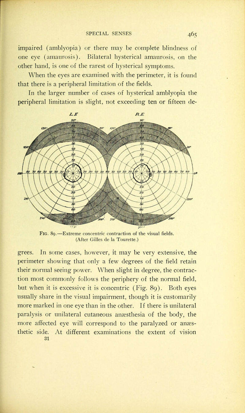 impaired (amblyopia) or there may be complete blindness of one eye (amaurosis). Bilateral hysterical amaurosis, on the other hand, is one of the rarest of hysterical symptoms. When the eyes are examined with the perimeter, it is found that there is a peripheral limitation of the fields. In the larger number of cases of hysterical amblyopia the peripheral limitation is slight, not exceeding ten or fifteen de- L.r R.B. Fig. 89.—Extreme concentric contraction of the visual fields. (After Gilles de la Tourette.) grees. In some cases, however, it may be very extensive, the perimeter showing that only a few degrees of the field retain their normal seeing power. When slight in degree, the contrac- tion most commonly follows the periphery of the normal field, but when it is excessive it is concentric (Fig. 89). Both eyes usually share in the visual impairment, though it is customarily more marked in one eye than in the other. If there is unilateral paralysis or unilateral cutaneous anaesthesia of the body, the more affected eye will correspond to the paralyzed or anaes- thetic side. At different examinations the extent of vision 31