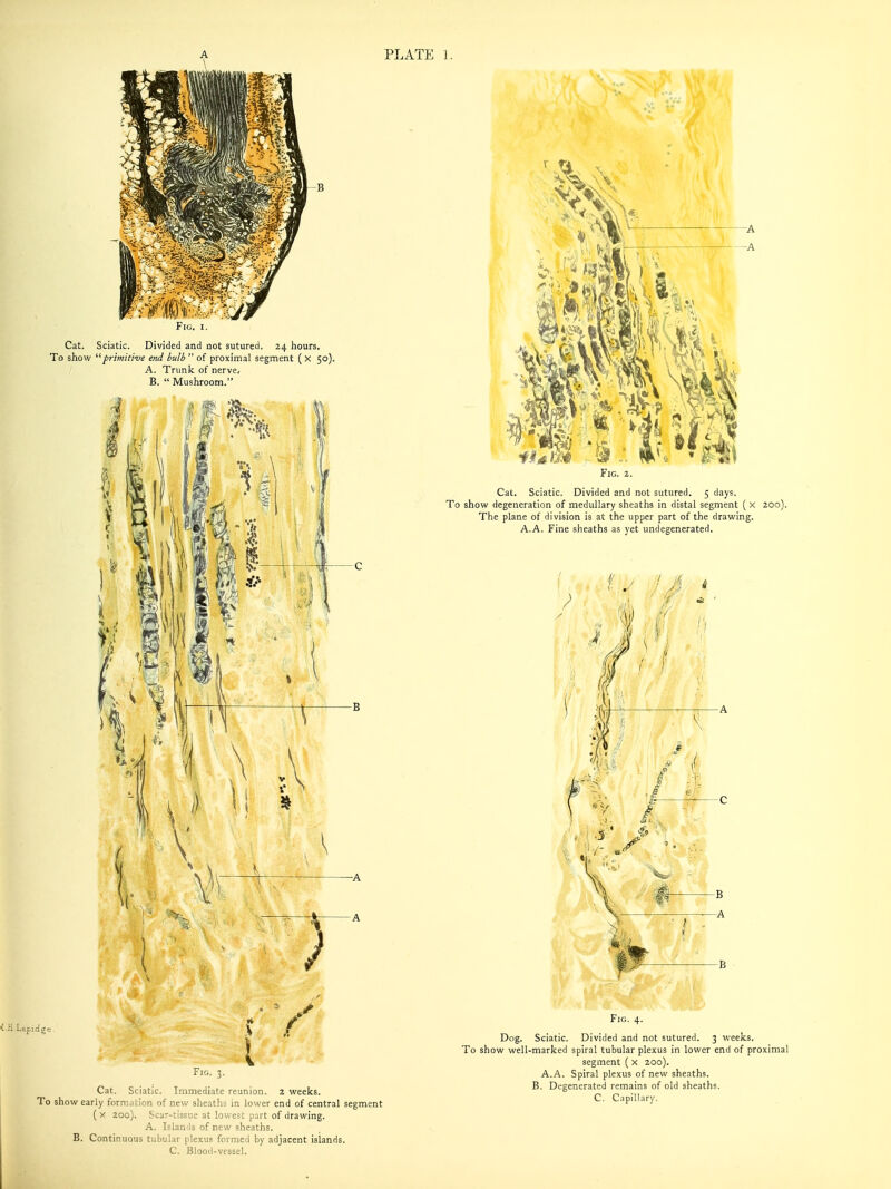 PLATE ]. Fig. I. Cat. Sciatic. Divided and not sutured. 24 hours. To show ^'frimiti-ve end bulb  of proximal segment ( X 50). A. Trunk of nerve, B.  Mushroom. H Lapidge ilG. 3. Cat. Sciatic. Immediate reunion. 2 weelcs. To show early formation of new sheaths in lower end of central segment ( X 200). Scar-tissue at lowest part of drawing. A. Islands of new sheaths. B. Continuous tubular plexus formed by adjacent islands. C. Blood-vessel. Fig. 2. Cat. Sciatic. Divided and not sutured. 5 days. To show degeneration of medullary sheaths in distal segment ( x 200). The plane of division is at the upper part of the drawing. A.A. Fine sheaths as yet undegenerated. Fig. 4. Dog. Sciatic. Divided and not sutured. 3 weeks. To show well-marked spiral tubular plexus in lower end of proximal segment ( x 200). A.A. Spiral plexus of new sheaths. B. Degenerated remains of old sheaths. C. Capillary.