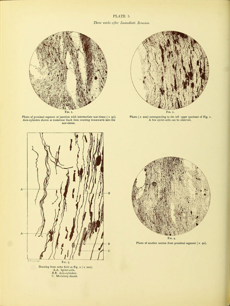 Three weeks after Immediate Reunion. Fig. 3. Drawing from same field as Fig. 2 ( x 200). A.A. Spider-cells. B. B. Axis-cylinders. C. Medullary sheath.