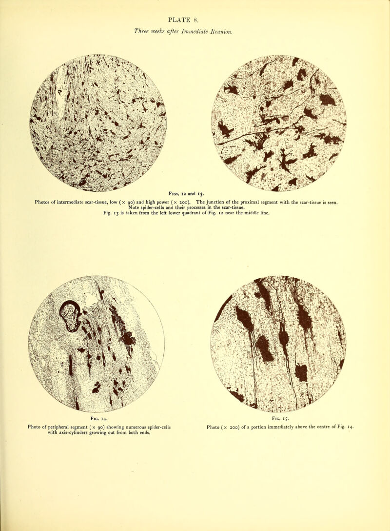 Three weeks after Immediate liewiion. Figs, iz and 13. Photos of intermediate scar-tissue, low ( x 90) and high power ( x 200). The junction of the proximal segment with the scar-tissue is seen. Note spider-cells and their processes in the scar-tissue. Fig. 13 is talcen from the left lower quadrant of Fig. 12 near the middle line.