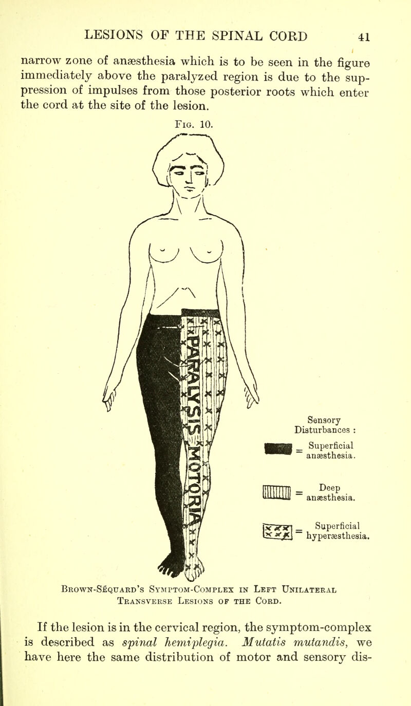 narrow zone of anaesthesia which is to be seen in the figure immediately above the paralyzed region is due to the sup- pression of impulses from those posterior roots which enter the cord at the site of the lesion. Sensory Disturbances : _ Superficial ~ anaesthesia. Deep anaesthesia. Superficial hyperaesthesia. Brown-Sequard's Symptom-Complex in Left Unilateral Transverse Lesions of the Cord. If the lesion is in the cervical region, the symptom-complex is described as spinal hemiplegia. Mutatis mutandis, we have here the same distribution of motor and sensory dis-