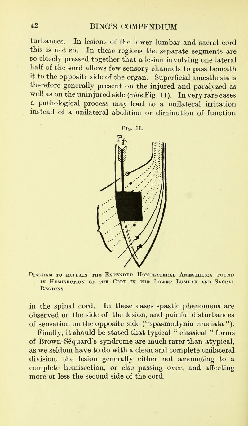 turbances. In lesions of the lower lumbar and sacral cord this is not so. In these regions the separate segments are so closely pressed together that a lesion involving one lateral half of the eord allows few sensory channels to pass beneath it to the opposite side of the organ. Superficial anaesthesia is therefore generally present on the injured and paralyzed as well as on the uninjured side (vide Fig. 11). In very rare cases a pathological process may lead to a unilateral irritation instead of a unilateral aboHtion or diminution of function Fig. 11. Diagram to explain the Extended Homolateral Anesthesia found . IN Hemisection of the Cord in the Lower Lumbar and Sacral Regions. in the spinal cord. In these cases spastic phenomena are observed on the side of the lesion, and painful disturbances of sensation on the opposite side (spasmodynia cruciata). Finally, it should be stated that typical  classical  forms of Brown-Sequard's S3rndrome are much rarer than atypical, as we seldom have to do with a clean and complete unilateral division, the lesion generally either not amounting to a complete hemisection, or else passing over, and affecting more or less the second side of the cord.