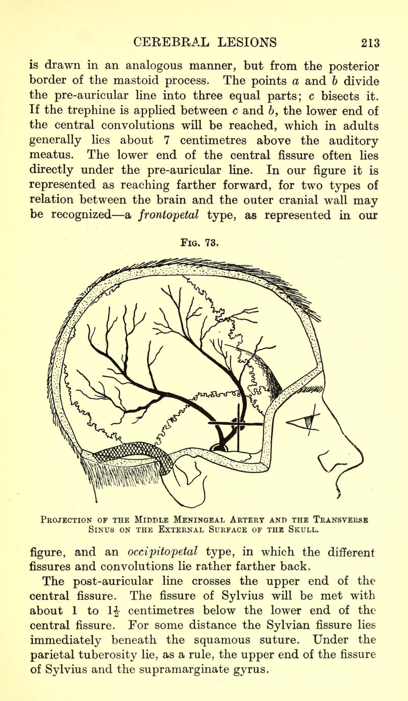 is drawn in an analogous manner, but from the posterior border of the mastoid process. The points a and 6 divide the pre-auricular Hne into three equal parts; c bisects it. If the trephine is applied between c and h, the lower end of the central convolutions will be reached, which in adults generally lies about 7 centimetres above the auditory meatus. The lower end of the central fissure often lies directly under the pre-auricular line. In our figure it is represented as reaching farther forward, for two types of relation between the brain and the outer cranial wall may be recognized—a froniopetal type, as represented in our Fig. 73. Projection of the Middle Meningeal Artery and the Transverse Sinus on the External Surface of the Skull. figure, and an occipitopetal type, in which the different fissures and convolutions lie rather farther back. The post-auricular line crosses the upper end of the central fissure. The fissure of Sylvius will be met with about 1 to li centimetres below the lower end of the central fissure. For some distance the Sylvian fissure lies immediately beneath the squamous suture. Under the parietal tuberosity lie, as a rule, the upper end of the fissure of Sylvius and the supramarginate gyrus.