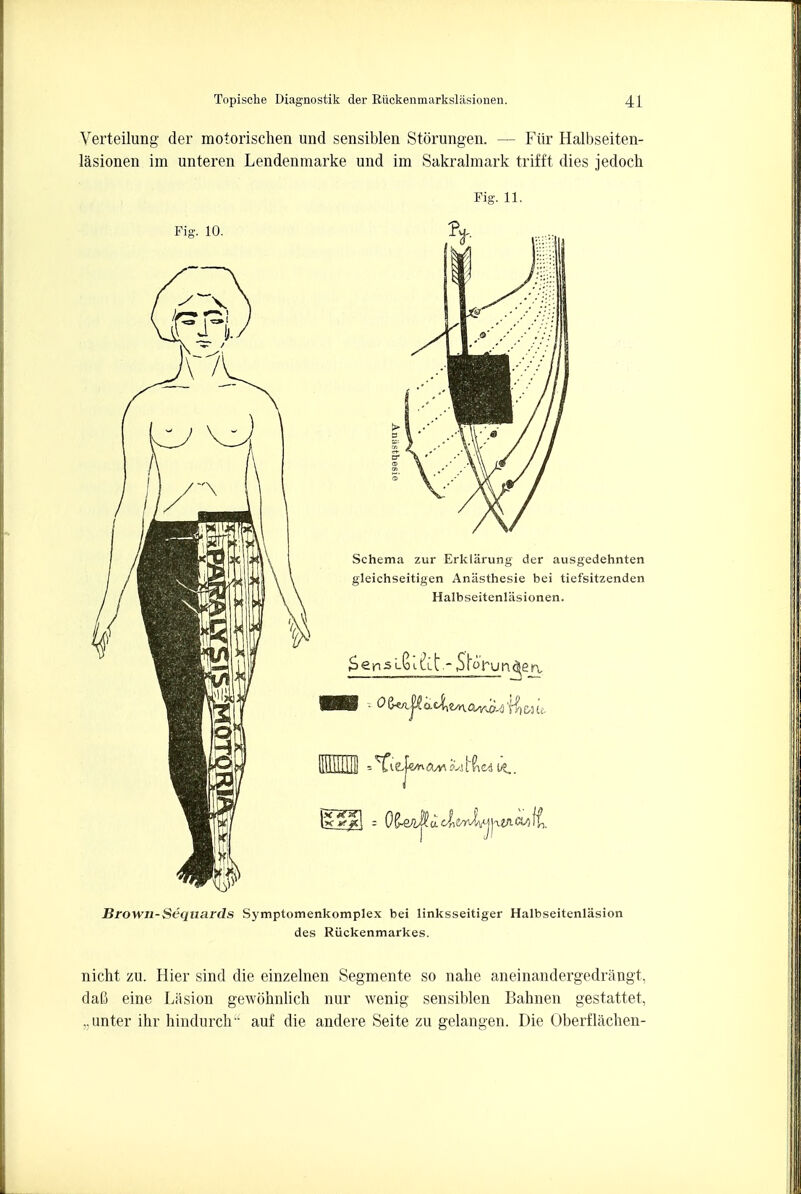 Verteilung der motorischen und sensiblen Storungen. — Fiir Halbseiten- lasionen im unteren Lendenmarke und im Sakralmark trifft dies jedoch Fig. 11. Brown-Sequards Symptomenkomplex bei linksseitiger Halbseitenlasion des Riickenmarkes. nicht zu. Hier sind die einzelnen Segmente so nalie aneinandergedraugt, daC eine Lasion gewohnlich nur wenig sensiblen Bahnen gestattet, ,.unter ihr hindurch auf die andere Seite zu gelangen. Die Oberflaclien-