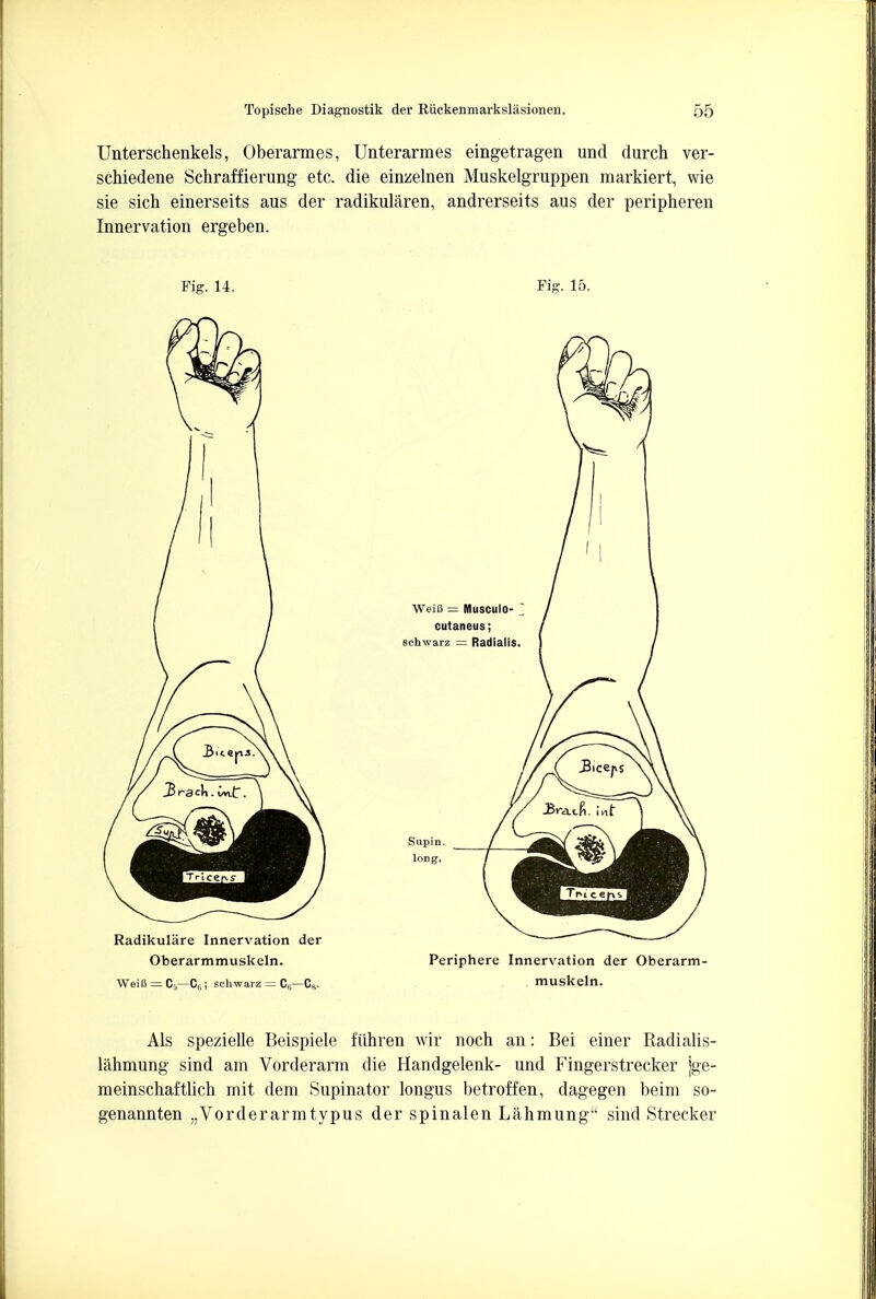 Unterschenkels, Oberarmes, Unterarmes eingetragen und durch ver- schiedene Schraffierung etc. die einzelnen Muskelgruppen markiert, wie sie sich einerseits aus der radikularen, andrerseits aus der peripheren Innervation ergeben. Fig. 14. Fig. 15. Oberarmmuskeln. Periphere Innervation der Oberarm- WeiB = C5—C6; schwarz = Cfi—CH. muskeln. Als spezielle Beispiele fiihren wir noch an: Bei einer Radialis- lahmung sind am Vorderarm die Handgelenk- und Fingerstrecker jge- meinschaftlich mit dem Supinator longus betroffen, dagegen beim so- genannten „Vorderarmtypus der spinalen Lahmung sind Strecker