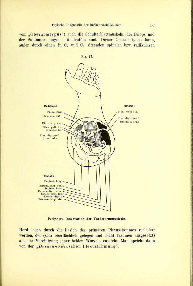 vom „Oberarmtypus) auch die Schulterblattmuskeln, der Biceps und der Supinator longus mitbetroffen sind. Dieser Oberarmtypus kann, aufier durch einen in C5 und Cc sitzenden spinalen bzw. radikularen Fig. 17. Periphere Innervation der Vorderarmmuskeln. Herd, auch durch die Lasion des primaren Plexusstammes realisiert werden, der (sehr oberflachlich gelegen und leicht Traumen ausgesetzt) aus der Vereinigung jener beiden Wurzeln entsteht. Man spricht dann von der „Duchenne-Erbschen Plexuslahmung.