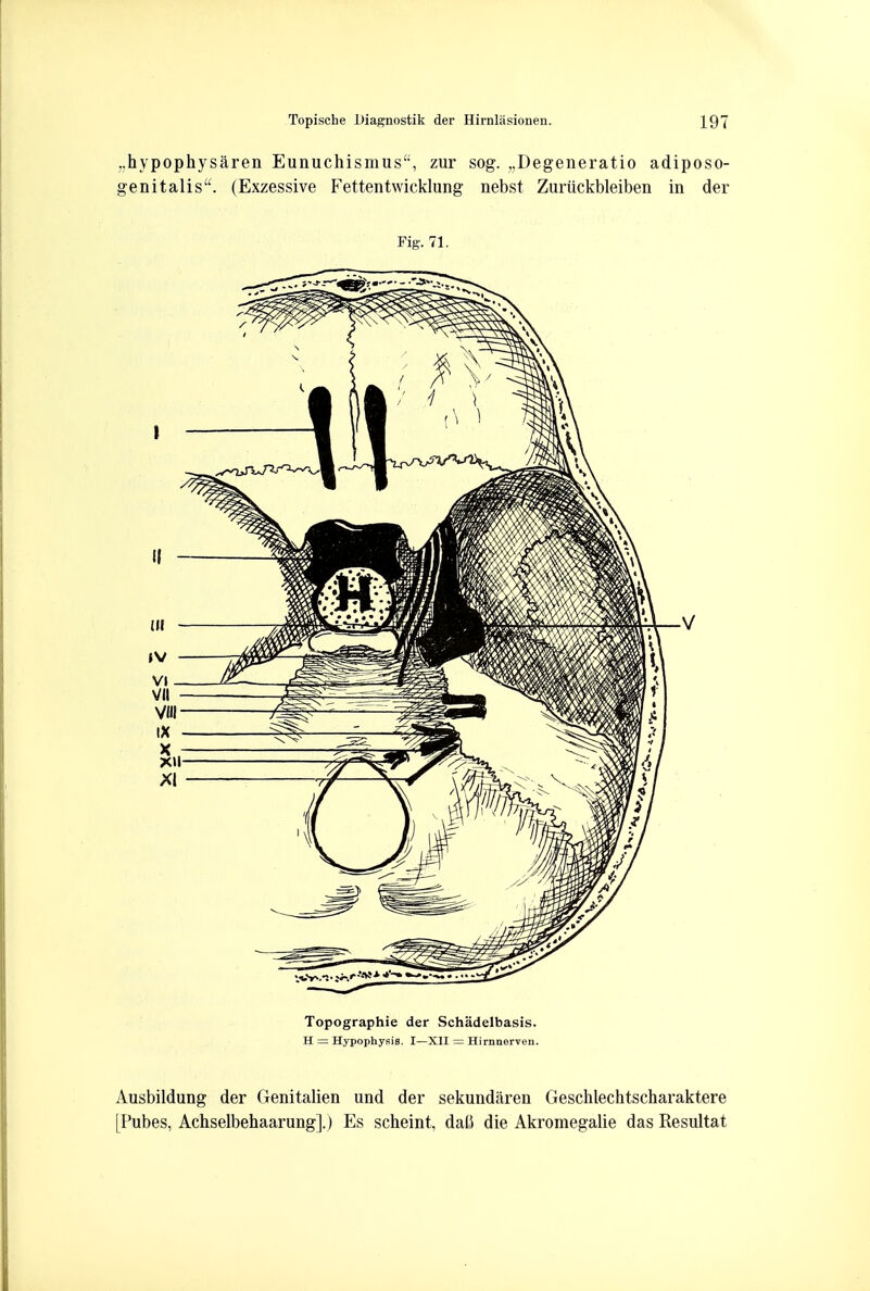 ..hypophysaren Eunuchismus, zur sog. ,,Degeneratio adiposo- genitalis. (Exzessive Fettentwicklung nebst Zuriickbleiben in der Fig. 71. Topographie der Schadelbasis. H = Hypophysis. I—XII — Hirnnerveu. Ausbildung der Genitalien und der sekundaren Geschlechtscharaktere (Pubes, Achselbehaarung].) Es scheint, da(J die Akromegalie dasResultat