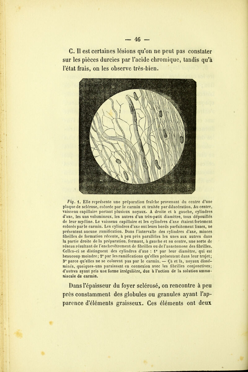 C. II est certaines lesions qu'on ne peut pas constater sur les pieces durcies par Facide chromique, tandis qu'a Petal frais, on les observe tres-bien. Fig. i. Elle repr^sente une preparation fraiche provenant du centre d'une plaque de sclerose, colored par le carmin et traite'e par dilaceration. Au centre, vaisseau capillaire portant plusieux noyaux. A droite et a gauche, cylindres d'axe, les uns volumineux, les autres d'un tres-petit diametre, tous ddpouilles de leur myeline. Le vaisseau capillaire et les cylindres d'axe etaient fortement colored par le carmin. Les cylindres d'axe ontleurs bords parfaitement lisses, ne presentent aucune ramification. Dans Fintervalle des cylindres d'axe, minces fibrilles de formation re*cente, a peu pres paralleles les unes aux autres dans la partie droite de la preparation, formant, a gauche et au centre, une sorte de reseau resultant de l'enchevetrement de fibrilles ou de l'anastomose des fibrilles. Celles-ci se distinguent des cylindres d'axe : 1° par leur diametre, qui est beaucoup moindre; 2° par les ramifications qu'elles presentent dans leur trajet; 3° parce qu'elles ne se colorent pas par le carmin. — Qa et la, noyaux disse- mines, queiques-uns paraissant en connexion avec les fibrilles conjonctives; d'autres ayant pris une forme irreguliere, due & Taction de la solution ammo- niscale de carmin. DansTepaisseur du foyer sclerose, on rencontre a peu pres constamment des globules ou granules ayant Tap- parence d'elements graisseux. Ces elements ont deux