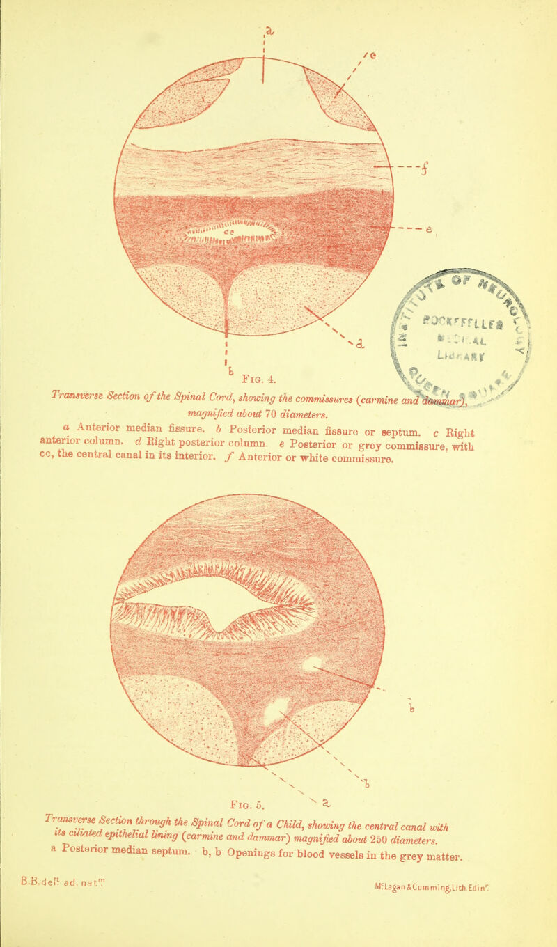 Fig. 4. Transverse Section of the Spinal Cord, showing the commissures (carmine anfa^ma^i magnified about 70 diameters, a Anterior median fissure, b Posterior median fissure or septum, c Right anterior column, d Eight posterior column, e Posterior or grey commissure, with cc, the central canal in its interior. / Anterior or white commissure. Fig. Transverse Section through the Spinal Cord of a Child, showing the central canal with its ciliated epithelial lining (carmine and dammar) magnified about 250 diameters. a Posterior median septum, b, b Openings for blood vessels in the grey matter. .B.def* ad. nat™ MfLagan&Ci»mming,Lith.Edin'