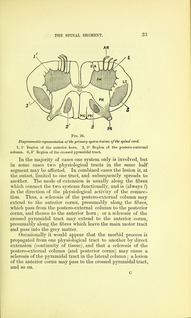 AR i Fig. 26. Diagrammatic representation of the primary system lesions of the spinal cord. 1,1' Region of the anterior horn. 2, 2' Region of the postero-external column. 3, 3' Region of the crossed pyramidal tract. In the majority of cases one system only is involved, but in some cases two physiological tracts in the same half segment may be affected. In combined cases the lesion is, at the outset, limited to one tract, and subsequently spreads to another. The mode of extension is usually along the fibres which connect the two systems functionally, and is (always ?) in the direction of the physiological activity of the connec- tion. Thus, a sclerosis of the postero-external column may extend to the anterior cornu, presumably along the fibres, which pass from the postero-external column to the posterior cornu, and thence to the anterior horn; or a sclerosis of the crossed pyramidal tract may extend to the anterior cornu, presumably along the fibres which leave the main motor tract and pass into the grey matter. Occasionally it would appear that the morbid process is propagated from one physiological tract to another by direct extension (continuity of tissue), and that a sclerosis of the postero-external column (and posterior cornu) may cause a sclerosis of the pyramidal tract in the lateral column; a lesion of the anterior cornu may pass to the crossed pyramidal tract, and so on. G