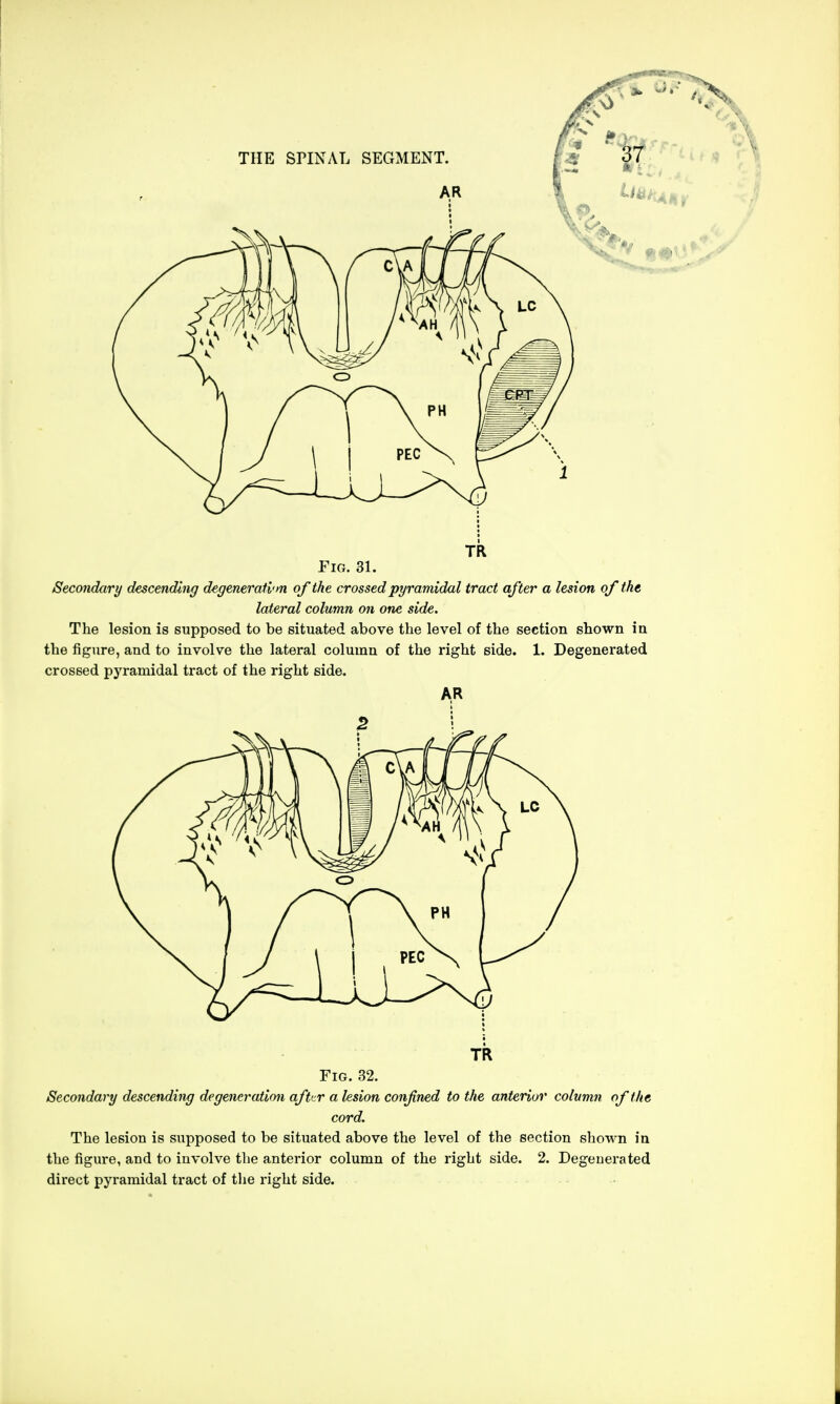 AR TR Fig. 31. Secondary descending degeneration of the crossed pyramidal tract after a lesion of the lateral column on one side. The lesion is supposed to be situated above the level of the section shown in the figure, and to involve the lateral column of the right side. 1. Degenerated crossed pj'ramidal tract of the right side. AR 5 TR Fig. 32. Secondary descending degeneration aftur a lesion confined to the anterior column of the cord. The lesion is supposed to be situated above the level of the section shown in the figure, and to involve the anterior column of the right side. 2. Degenerated direct pyramidal tract of the right side.