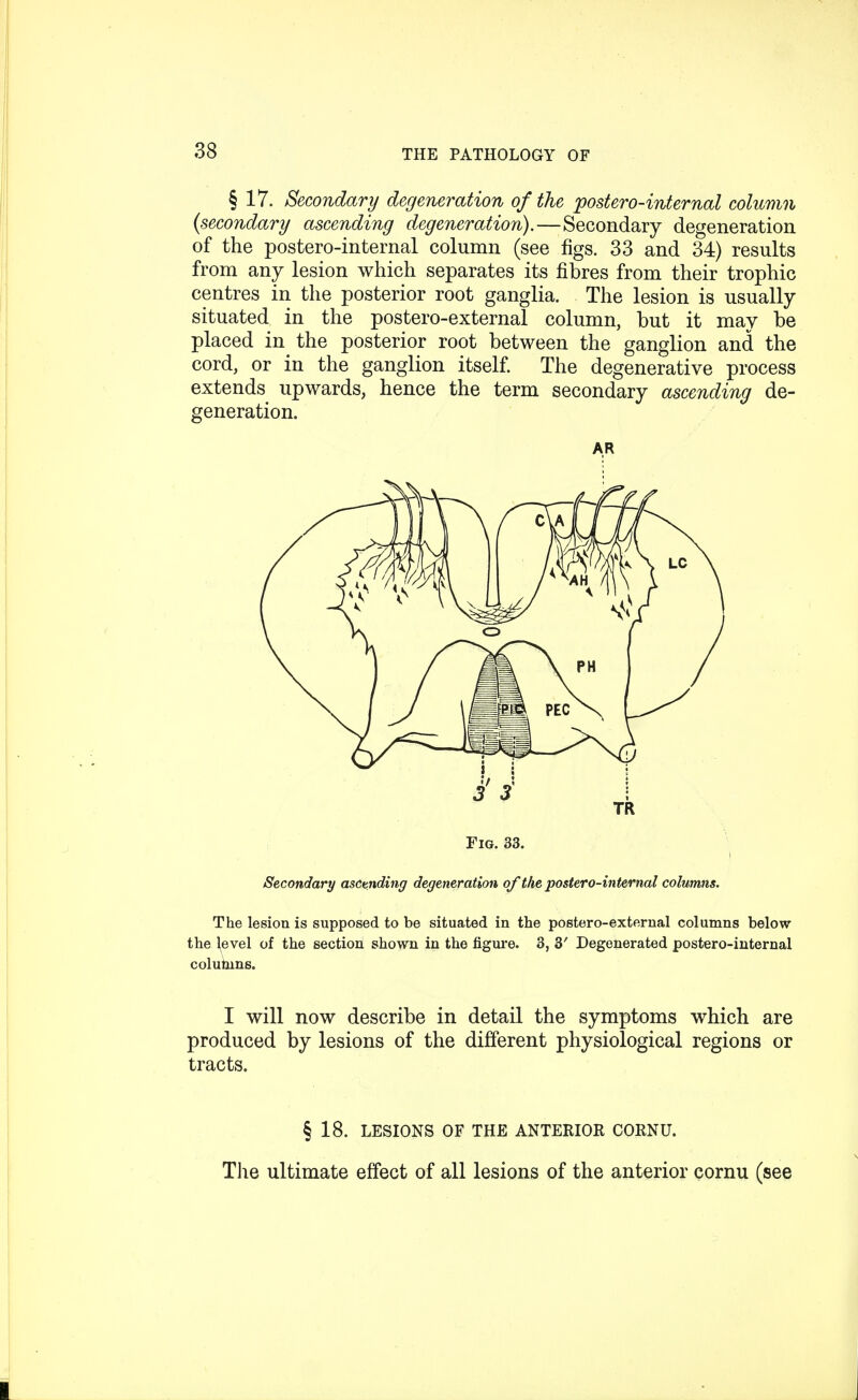 § 17. Secondary degeneration of the postero-internal column (secondary ascending degeneration).—Secondary degeneration of the postero-internal column (see figs. 33 and 34) results from any lesion which separates its fibres from their trophic centres in the posterior root ganglia. The lesion is usually situated in the postero-external column, but it may be placed in the posterior root between the ganglion and the cord, or in the ganglion itself. The degenerative process extends upwards, hence the term secondary ascending de- generation. AR Secondary asctnding degeneration of the postero-internal columns. The lesion is supposed to be situated in the postero-external columns below the level of the section shown in the figure. 3, 3' Degenerated postero-internal coluhins. I will now describe in detail the symptoms which are produced by lesions of the different physiological regions or tracts. § 18. LESIONS OF THE ANTERIOR CORNU. The ultimate effect of all lesions of the anterior cornu (see