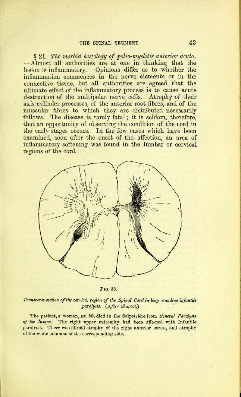 § 21. The morbid histology of polio-myelitis anterior acuta. —Almost all authorities are at one in thinking that the lesion is inflammatory. Opinions differ as to whether the inflammation commences in the nerve elements or in the connective tissue, but all authorities are agreed that the ultimate effect of the inflammatory process is to cause acute destruction of the multipolar nerve cells. Atrophy of their axis cylinder processes, of the anterior root fibres, and of the muscular fibres to which they are distributed necessarily follows. The disease is rarely fatal; it is seldom, therefore, that an opportunity of observing the condition of the cord in the early stages occurs. In the few cases which have been examined, soon after the onset of the affection, an area of inflammatory softening was found in the lumbar or cervical regions of the cord. Fig. 38. Transverse section of the cervica. region of the Spinal Cord in long standing infantile paralysis. (After Charcot.) The patient, a woman, set. 50, died in the Salpetridre from General Paralysis oj the Insane. The right upper extremity had been affected with Iofantile paralysis. There was fibroid atrophy of the right anterior cornu, and atrophy of the white columns of the corresponding side.