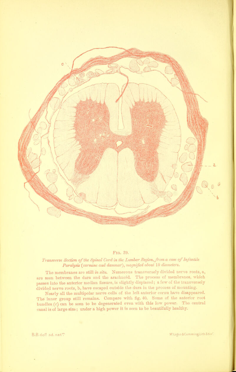 Transverse Section of the /Spinal Cord in the Lumbar Region, from a case of Infantile Paralysis (carmine and dammar), magnified about 10 diameters. The membranes are still in situ. Numerous transversely divided nerve roots, a, are seen between the dura and the arachnoid. The process of membranes, which passes into the anterior median fissure, is slightly displaced; a few of the transversely divided nerve roots, b, have escaped outside the dura in the process of mounting. Nearly all the multipolar nerve cells of the left anterior cornu have disappeared. The inner group still remains. Compare with fig. 40. Some of the anterior root bundles (c) can be seen to be degenerated even with this low power. The central canal is of large size; under a high power it is seen to be beautifully healthy.