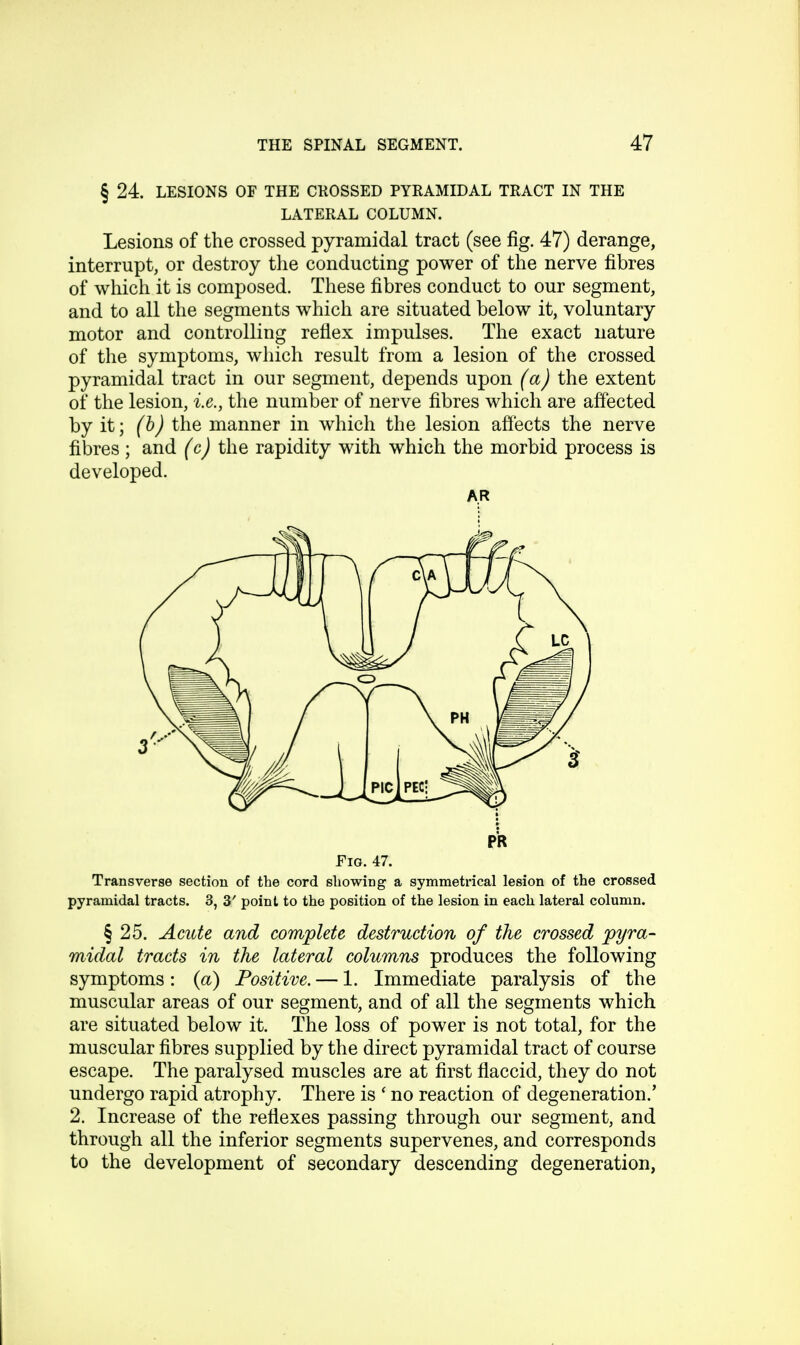 § 24. LESIONS OF THE CROSSED PYRAMIDAL TRACT IN THE LATERAL COLUMN. Lesions of the crossed pyramidal tract (see fig. 47) derange, interrupt, or destroy the conducting power of the nerve fibres of which it is composed. These fibres conduct to our segment, and to all the segments which are situated below it, voluntary motor and controlling reflex impulses. The exact nature of the symptoms, which result from a lesion of the crossed pyramidal tract in our segment, depends upon (a) the extent of the lesion, i.e., the number of nerve fibres which are affected by it; (b) the manner in which the lesion affects the nerve fibres ; and (c) the rapidity with which the morbid process is developed. AR Fig. 47. Transverse section of the cord showing a symmetrical lesion of the crossed pyramidal tracts. 3, 3' point to the position of the lesion in each lateral column. § 25. Acute and complete destruction of the crossed pyra- midal tracts in the lateral columns produces the following symptoms: (a) Positive. — 1. Immediate paralysis of the muscular areas of our segment, and of all the segments which are situated below it. The loss of power is not total, for the muscular fibres supplied by the direct pyramidal tract of course escape. The paralysed muscles are at first flaccid, they do not undergo rapid atrophy. There is ' no reaction of degeneration.' 2. Increase of the reflexes passing through our segment, and through all the inferior segments supervenes, and corresponds to the development of secondary descending degeneration,