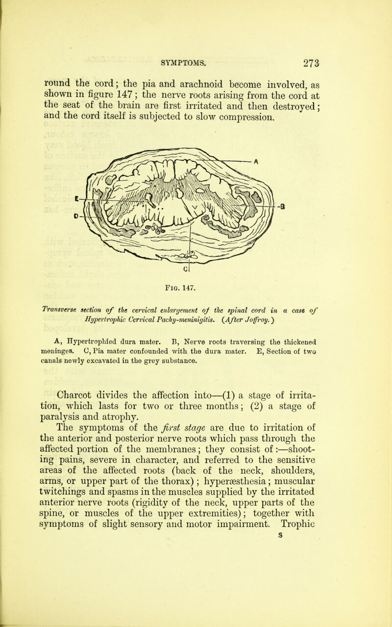 round the cord; the pia and arachnoid become involved, as shown in figure 147; the nerve roots arising from the cord at the seat of the brain are first irritated and then destroyed; and the cord itself is subjected to slow compression, Fig. 147. Transverse section of the cervical enlargement of the spinal cord in a case of Hypertrophic Cervical Pachy-meninigitis. (After Joffroy.) A, Hypertrophied dura mater. B, Nerve roots traversing the thickened meninges. 0, Pia mater confounded with the dura mater. E, Section of two canals newly excavated in the grey substance. Charcot divides the affection into—(1) a stage of irrita- tion, which lasts for two or three months; (2) a stage of paralysis and atrophy. The symptoms of the first stage are due to irritation of the anterior and posterior nerve roots which pass through the affected portion of the membranes; they consist of :—shoot- ing pains, severe in character, and referred to the sensitive areas of the affected roots (back of the neck, shoulders, arms, or upper part of the thorax) ; hyperesthesia; muscular twitchings and spasms in the muscles supplied by the irritated anterior nerve roots (rigidity of the neck, upper parts of the spine, or muscles of the upper extremities); together with symptoms of slight sensory and motor impairment. Trophic s