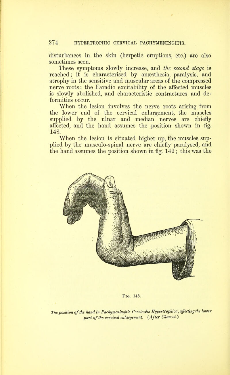 disturbances in the skin (herpetic eruptions, etc.) are also sometimes seen. These symptoms slowly increase, and the second stage is reached; it is characterised by anaesthesia, paralysis, and atrophy in the sensitive and muscular areas of the compressed nerve roots; the Faradic excitability of the affected muscles is slowly abolished, and characteristic contractures and de- formities occur. When the lesion involves the nerve roots arising from the lower end of the cervical enlargement, the muscles supplied by the ulnar and median nerves are chiefly affected, and the hand assumes the position shown in fig. 148. When the lesion is situated higher up, the muscles sup- plied by the musculo-spinal nerve are chiefly paralysed, and the hand assumes the position shown in fig. 149; this was the Fig. 148. The position of the hand in Pachymeningitis Cervicalis Hypertrophica, affecting the lower part of the cervical enlargement. {After Charcot.)