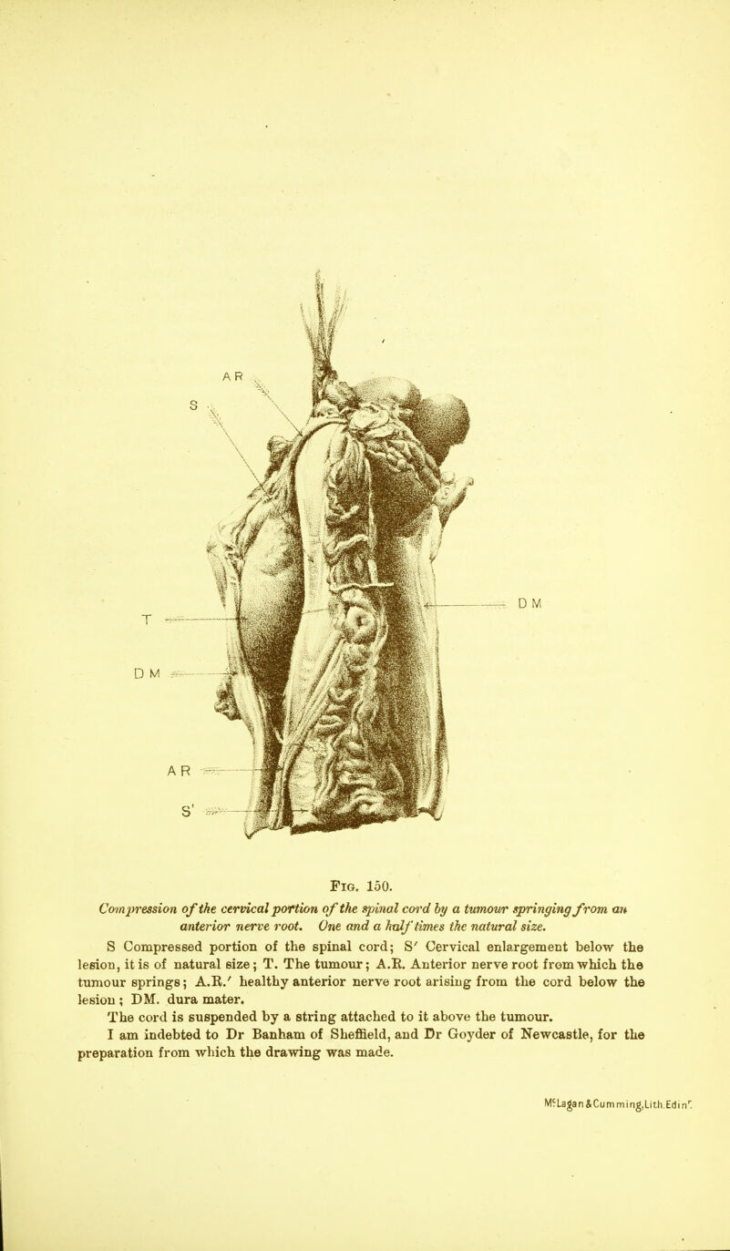 Compression of the cervical portion of the spinal cord by a tumour springing from an anterior nerve root. One and a half times the natural size. S Compressed portion of the spinal cord; S' Cervical enlargement below the lesion, it is of natural size; T. The tumour; A.R. Anterior nerve root from which the tumour springs; A.R.' healthy anterior nerve root arising from the cord below the lesion ; DM. dura mater. The cord is suspended by a string attached to it above the tumour. I am indebted to Dr Banham of Sheffield, and Dr Goyder of Newcastle, for the preparation from which the drawing was made.