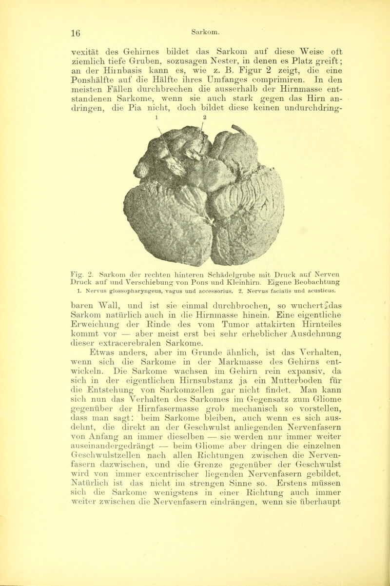 vexitat des Gehirnes bildet das Sarkom auf diese Weise oft ziemlich tiefe Gruben, sozusagen Nester, in denen es Platz greift; an der Himbasis kann es, wie z. B. Figur 2 zeigt, die eine Ponskalfte auf die Halfte ihres Umfanges comprimiren. In den meisten Fallen durckbrechen die ausserhalb der Hirnmasse ent- standenen Sarkome, wenn sie auck stark gegen das Hirn an- dringen, die Pia nicht, dock bildet diese keinen undurckdring- Fig. 2. Sarkom der rechten hinteren Schadelgrube mit Druck auf Nerven Druck auf und Verschiebung von Pons und Kleinhirn. Eigene Beobachtung 1. Nervus glossopharyngeus, vagus und accessorius. 2. Nervus facialis und acusticus. baren Wall, und ist sie einmal durckbrocken, so wuckertfdas Sarkom natiirlick auck in die Hirnmasse kinein. Eine eigentlicke Erweickung der Rinde des vom Tumor attakirten Hirnteiles kommt vor — aber meist erst bei sekr erkeblicker Ausdeknung dieser extracerebral en Sarkome. Etwas anders, aber im Grunde aknlick, ist das Yerkalten, wenn sick die Sarkome in der Markmasse des Gekirns ent- wickeln. Die Sarkome wacksen im Gekirn rein expansiv, da sick in der eigentlicken Hirnsubstanz ja ein Mutterboden fur die Entstekung von Sarkomzellen gar nickt findet. Man kann sick nun das Yerkalten des Sarkomes im Gegensatz zum Gliome gegeniiber der Hirnfasermasse grob meckanisck so vorstellen, dass man sagt: beim Sarkome bleiben, auck wenn es sick aus- deknt, die direkt an der Gesckwulst anliegenden Nervenfasern von Anfang an immer dieselben — sie werden nur immer weiter auseiuandergedrangt — beim Gliome aber dringen die einzelnen Gesckwulstzellen nack alien Ricktungen zwiscken die Nerven- fasern dazwiscken, und die Grenze gegeniiber der Gesckwulst wird von immer excentriscker liegenden Nervenfasern gebildet. Natiirlick ist das nickt im strengen Sinne so. Erstens miissen sick die Sarkome wenigstens in einer Ricktung auck immer weiter zwiscken die Nervenfasern eindrangen, wenn sie tiberkaupt