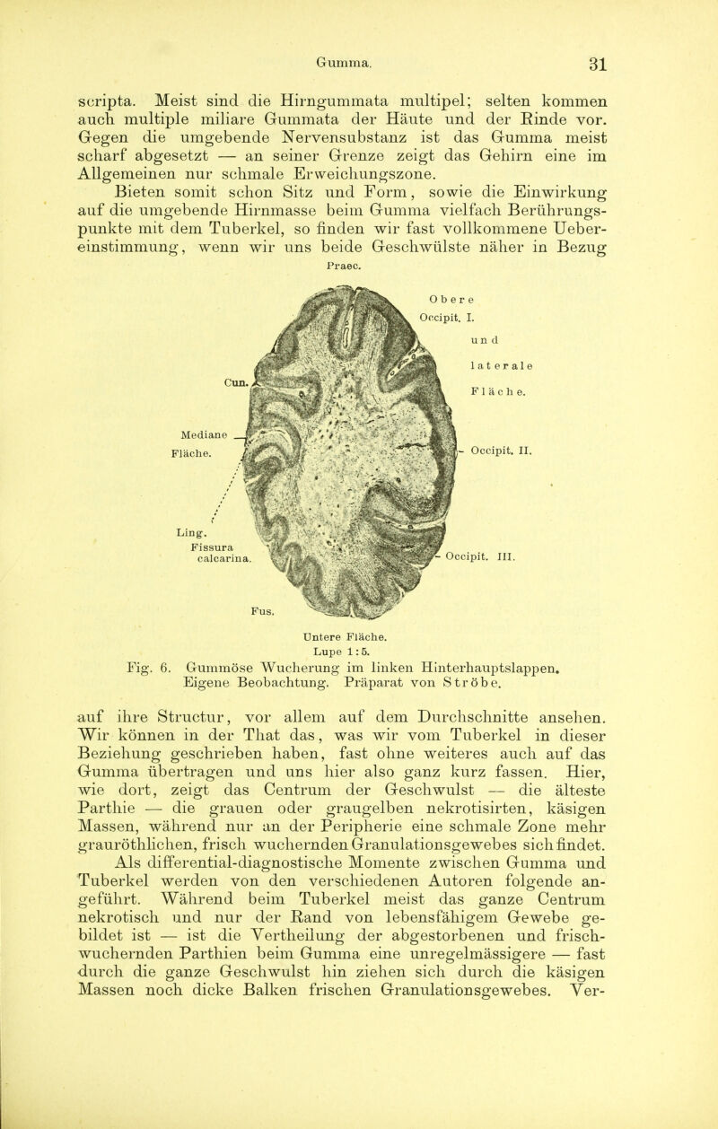 seripta. Meist sind die Hirngummata multipel; selten kommen auch multiple miliare Gummata der Haute und der Einde vor. Gegen die umgebende Nervensubstanz ist das Gumma meist scharf abgesetzt — an seiner Grenze zeigt das Gehirn eine im Allgemeinen nur schmale Erweicliungszone. Bieten somit schon Sitz und Form, sowie die Einwirkung auf die umgebende Hirnmasse beim Gumma vielfach Beruhrungs- punkte mit dem Tuberkel, so fmden wir fast vollkommene Ueber- einstimmung, wenn wir uns beide Geschwiilste naher in Bezug Praec. n d at erale Cun. ^ 4 • Am Flache. Mediane __Jf Flache. jk Occipit. II, Ling. Fissura calcarina. Fus. sipit. III. Fig. Untere Flache. Lupe 1:5. 6. Gummose Wucherung im linken Hinterhauptslappen. Eigene Beobachtung. Praparat von Strobe. auf ihre Structur, vor all em auf dem Durchschnitte ansehen. Wir konnen in der That das, was wir vom Tuberkel in dieser Beziehung geschrieben haben, fast ohne weiteres audi auf das Gumma ubertragen und uns hier also ganz kurz fassen. Hier, wie dort, zeigt das Centrum der Geschwulst — die alteste Parthie — die grauen oder graugelben nekrotisirten, kasigen Massen, wahrend nur an der Peripherie eine schmale Zone mehr graurothlichen, frisch wucherndenGranulationsgewebes sichfindet. Als differential-diagnostische Momente zwischen Gumma und Tuberkel werden von den verschiedenen Autoren folgende an- gefuhrt. Wahrend beim Tuberkel meist das ganze Centrum nekrotisch und nur der Rand von lebensfahigem Gewebe ge- bildet ist — ist die Yertheilung der abgestorbenen und frisch- wuchernden Parthien beim Gumma eine unregelmassigere — fast durch die ganze Geschwulst hin ziehen sich durch die kasigen Massen noch dicke Balken frischen Granulationsgewebes. Yer-