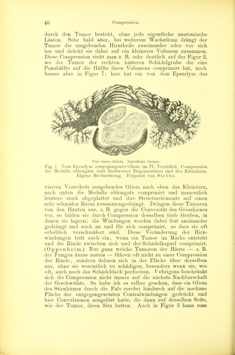 (lurch den Tumor besteht, ohne jede eigentliche anatomische Lasion. Sehr bald aber, bei weiterem Wachsthum drangt der Tumor die umgebenden Hirntheile auseiuander oder vor sich lier und driickt sie dabei auf em kleineres Yolumen zusammen. Diese Compression sieht man z. B. sehr deutlich auf der Figur 2, wo dei Tumor der rechten hinteren Schadelgrube die eine Poushalfte auf die Halfte ihres Yolumeus comprimirt hat, noch besser aber in Figur 7; hier hat em von dem Ependym des Von einem Kinde. Naturliche Grosse. Fig. 7. Vom Ependym ausgegangenes Gliom im IV. Ventrikel. Compression der Medulla oblongata (mit theilweiser Degeneration) und des Kleinhirns. Eigene Beobachtung. Praparat von Strobe. vierten Ventrikels ausgehendes Gliom nach oben das Kleinhirn, nach unten die Medulla oblongata comprimirt und namentlich letztere stark abgeplattet und ihre Structurelemente auf einen sehr schmalen Eaum zusammengedrangt. Dringen diese Tumoren von den Hauten aus, z. B. gegen die Convexitat des Grosshirnes vor, so bilden sie durch Compression desselben tiefe Gruben, in denen sie lagern; die Windungen werden dabei fest aneinander gedrangt und auch an und fur sich comprimirt, so class sie oft erheblich verschmalert sind. Diese Veranderung der Hirn- windungen tritt auch ein, wenn ein Tumor im Marke entsteht und die Rinde zwischen sich und der Schadelkapsel comprimirt. (Oppenheim.) Nur ganz weiche Tumoren der Haute — z. B. der Fungus durae matris — fuhren oft nicht zu emer Compression der Rinde, sondern dehnen sich in der Flache iiber derselben aus, ohne sie wesentlich zu schadigen, besonders weun sie, wie oft, auch noch das Schadeldach perforiren. Tlebrigens beschrankt sich die Compression nicht immer auf die nachste Nachbarschaft der Geschwiilste. So habe ich es selber gesehen, dass ein Gliom des Stirnhirnes durch die Falx cerebri hindurch auf die mediane Flache der entgegengesetzteu Centralwindungen gedriickt und hier Convulsionen ausgelost hatte, die dann auf derselben Seite, wie der Tumor, ihren Sitz hatten. Auch in Figur 3 kann man