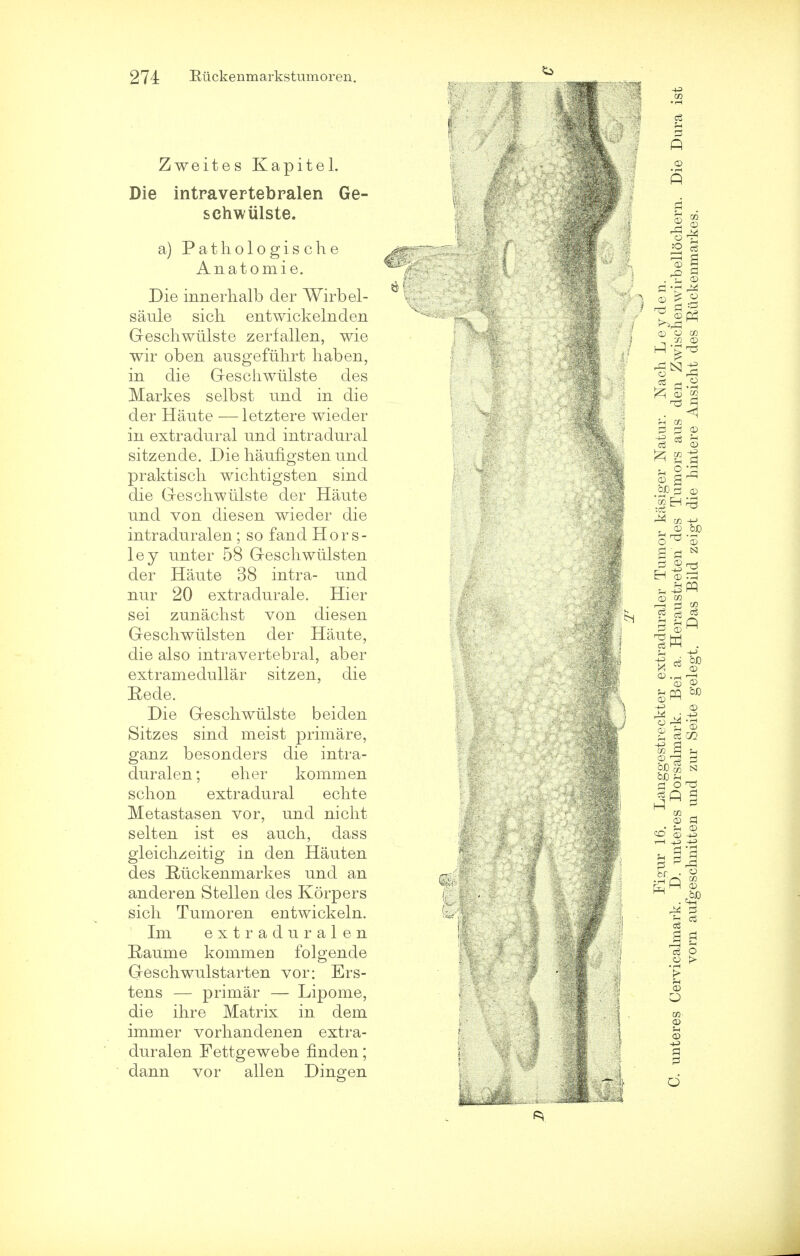 Zweites Kapitel. Die intravertehralen Ge- schwiilste. a) Pathologische Anatomie. Die innerhalb der Wirbel- saule sicli entwickelnden Geschwiilste zerfallen, wie wir oben ausgefuhrt haben, in die Geschwiilste des Markes selbst und in die der Haute — letztere wieder in extradural und intradural sitzende. Die haungsten und praktiscli wichtigsten sind die Geschwiilste der Haute und von diesen wieder die intraduralen; so fand H o r s - ley unter 58 Geschwiilsten der Haute 38 intra- und nur 20 extradurals Hier sei zunachst von diesen Geschwiilsten der Haute, die also intravertebral, aber extramedullar sitzen, die Rede. Die Geschwiilste beiden Sitzes sind meist primare, ganz besonders die intra- duralen ; eher kommen schon extradural echte Metastasen vor, und nicht selten ist es auch, dass gleichzeitig in den Hauten des E-iickenmarkes und an anderen Stellen des Korpers sich Turnoren entwickeln. Im extraduralen Raume konimeu folgende Geschwulstarten vor: Ers- tens — primar — Lipome, die ihre Matrix in dem immer vorhandenen extra- duralen Fettgewebe linden; dann vor alien Dingen